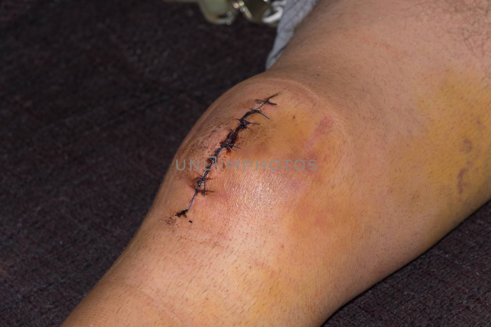 Male knee after surgical operation, knee replacement. Knee surgery in the hospital