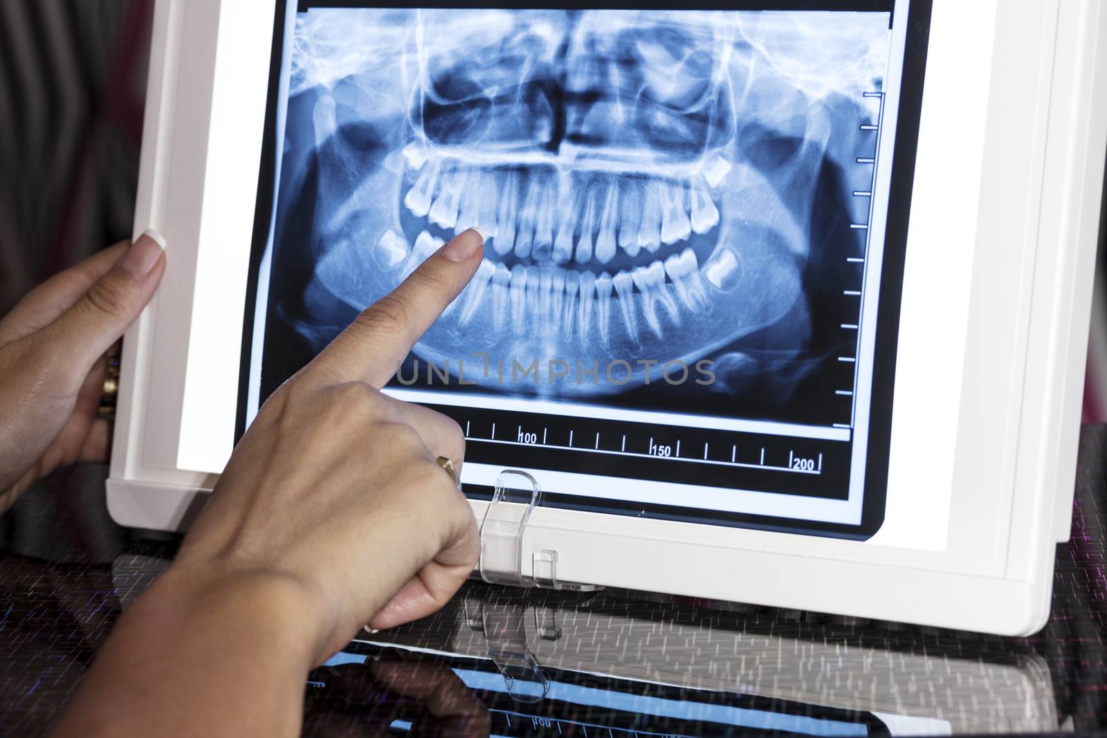 Dental Panoramic X-ray by orcearo