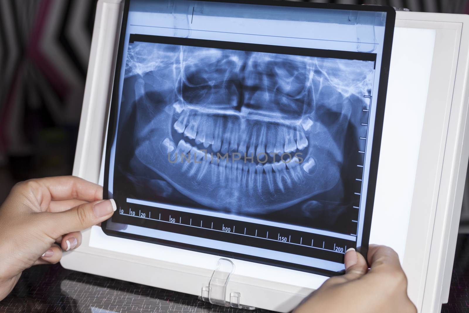 Hand Holding Dental Panoramic X-Ray 