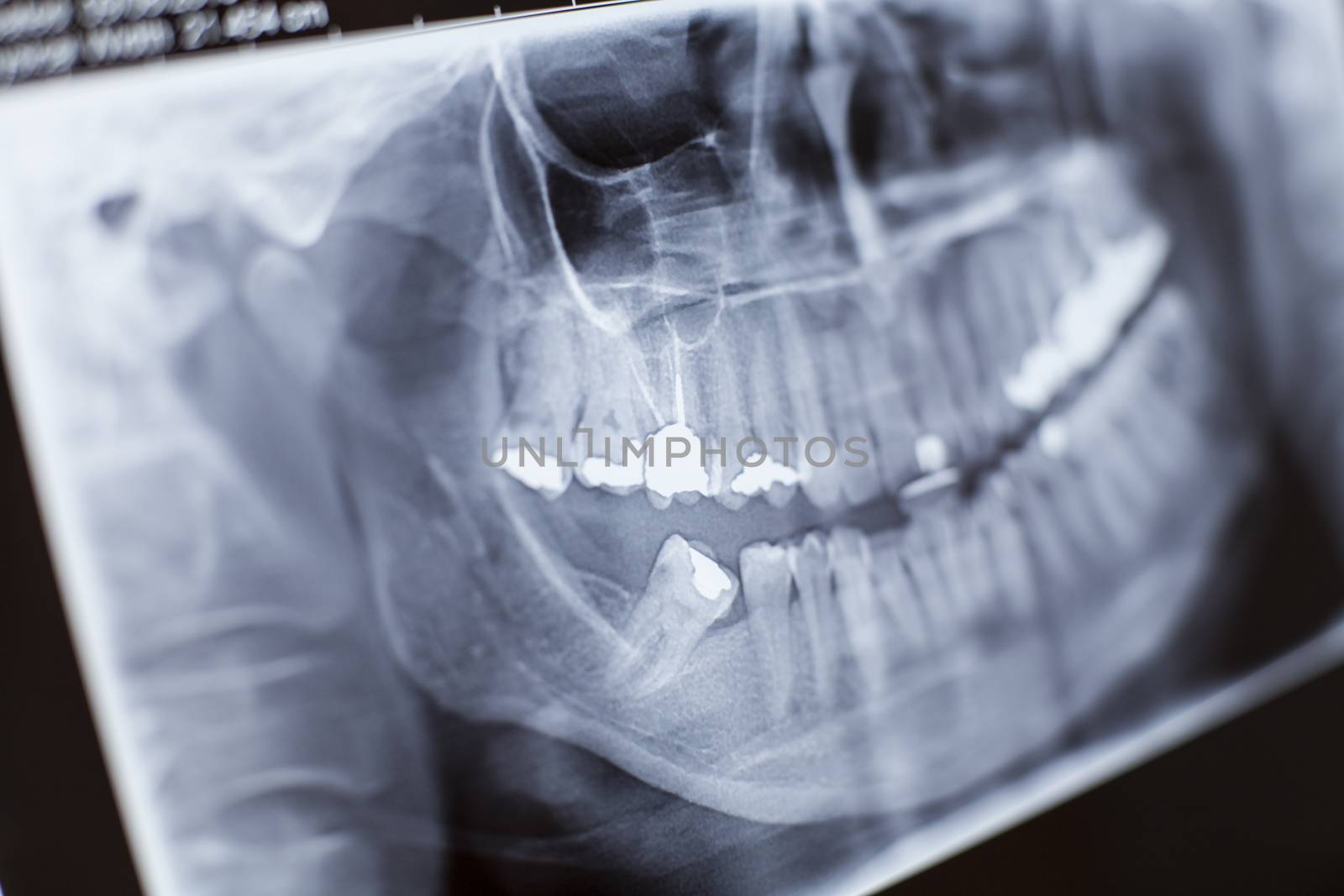 X-ray Close-up by orcearo