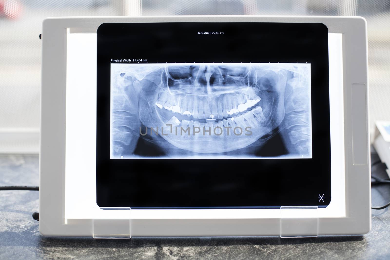 Dental panoramic xray in an x-ray viewer