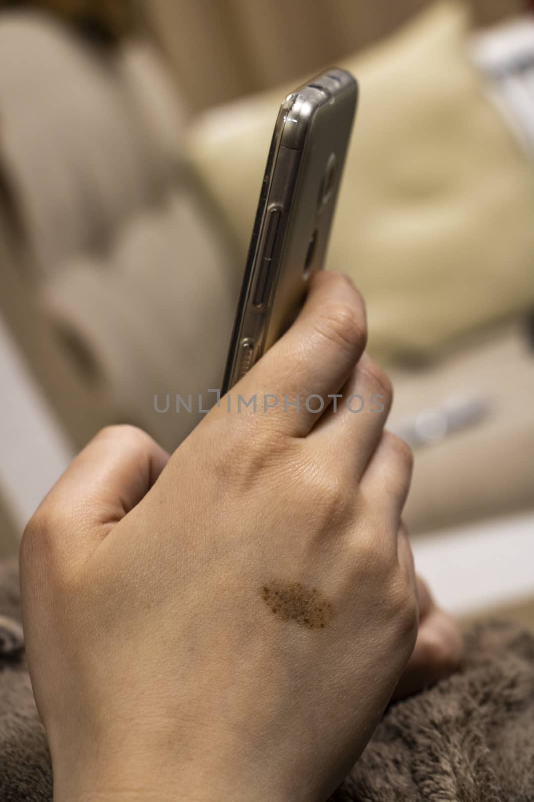 The girl, with a birthmark on her hand, using smart phone