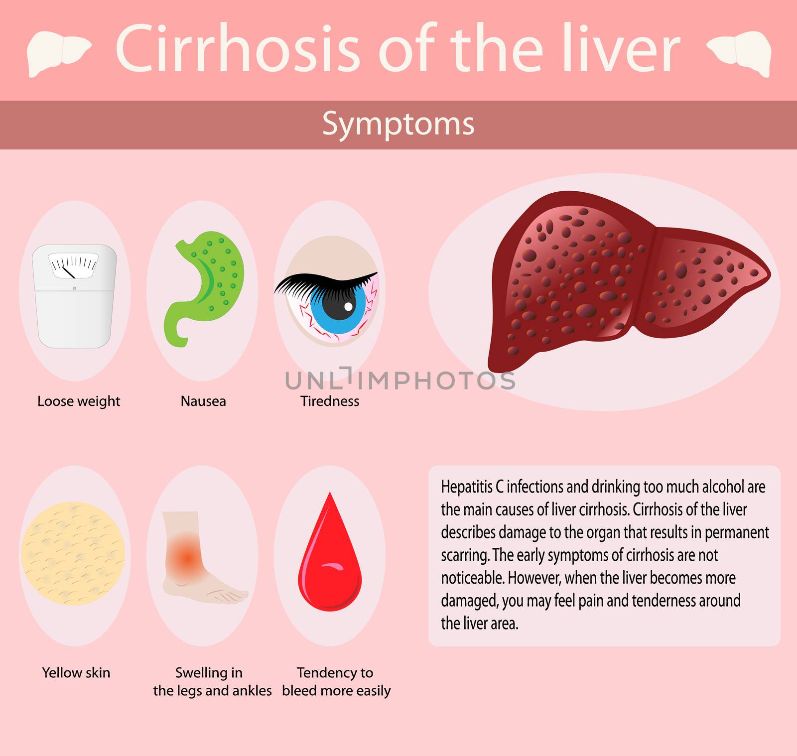 Symptoms of cirrosis of the liver. Liver diseases. infographic Vector illustration