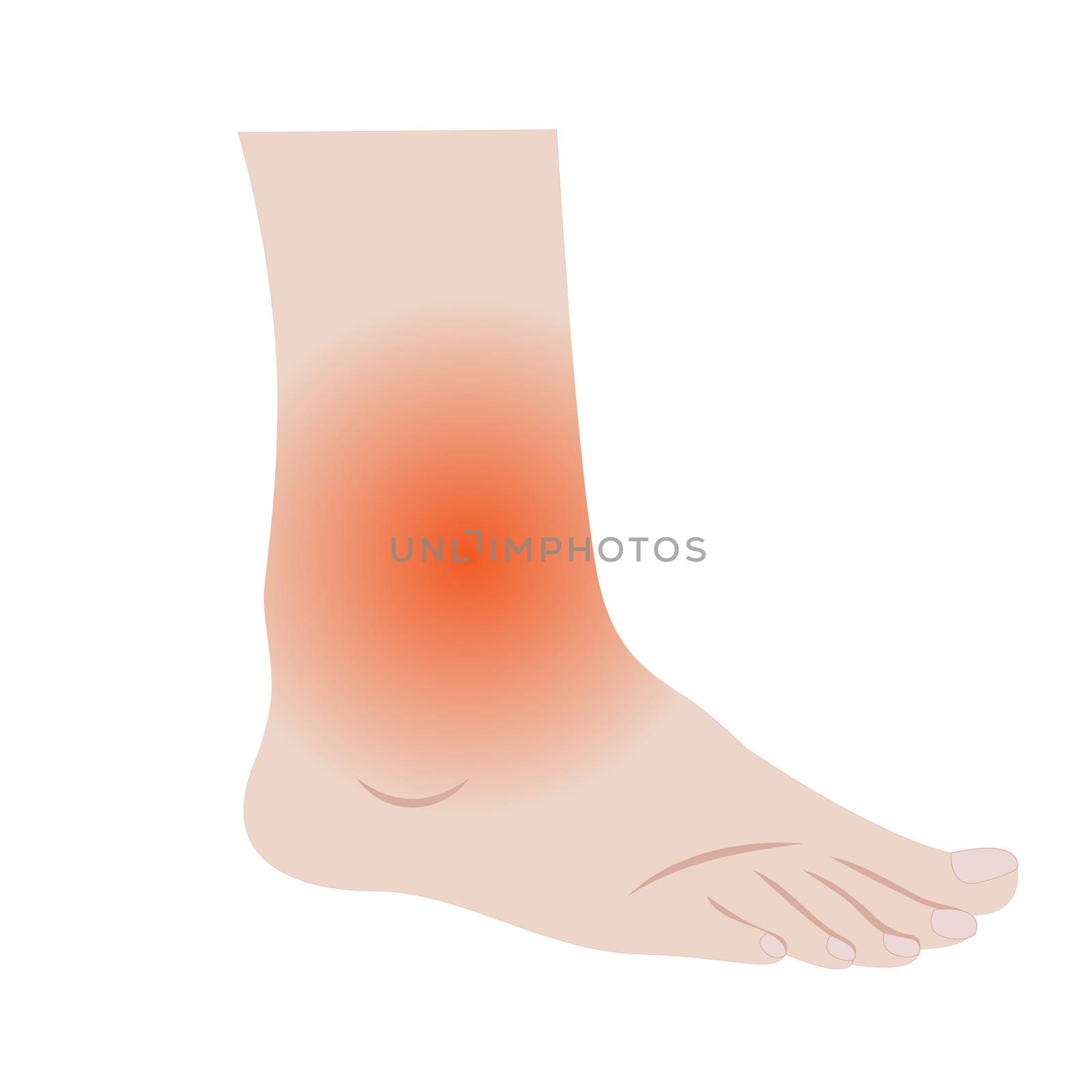 Swelling of the feet and ankles from infected or injury vector illustration on a white background isolated