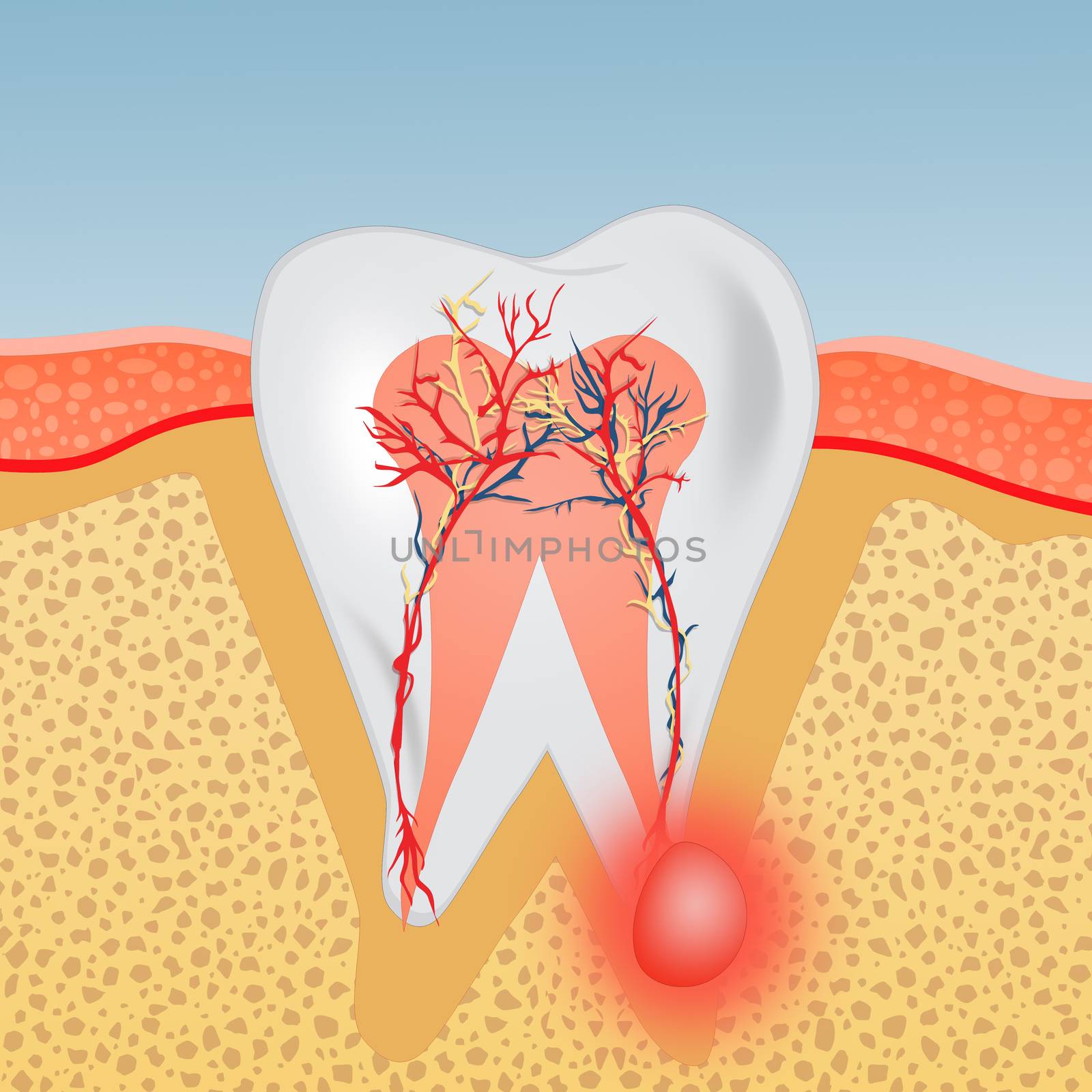 illustration of tooth with abscess