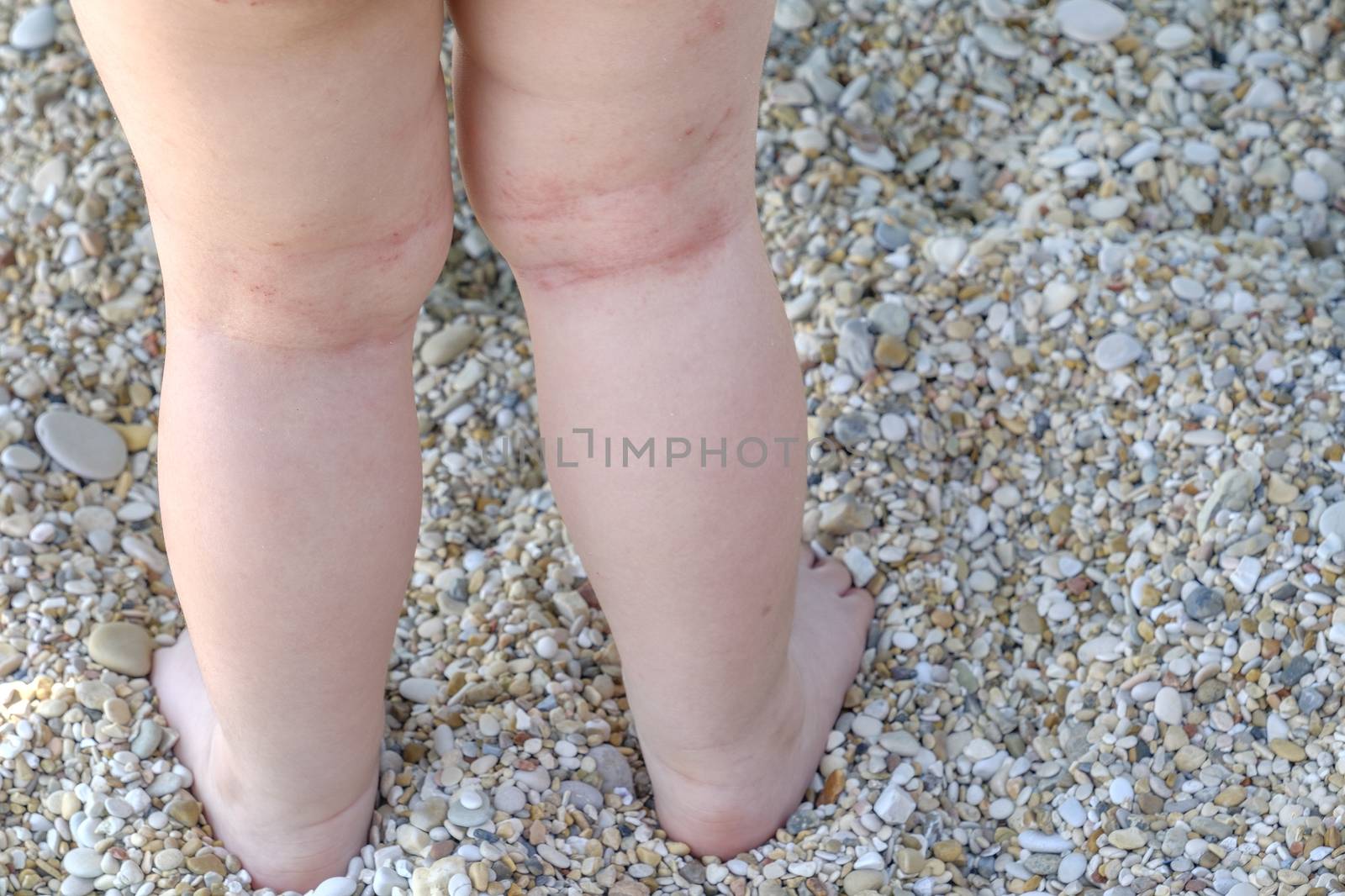 skin irritation newborn atopic dermatitis legs by LucaLorenzelli