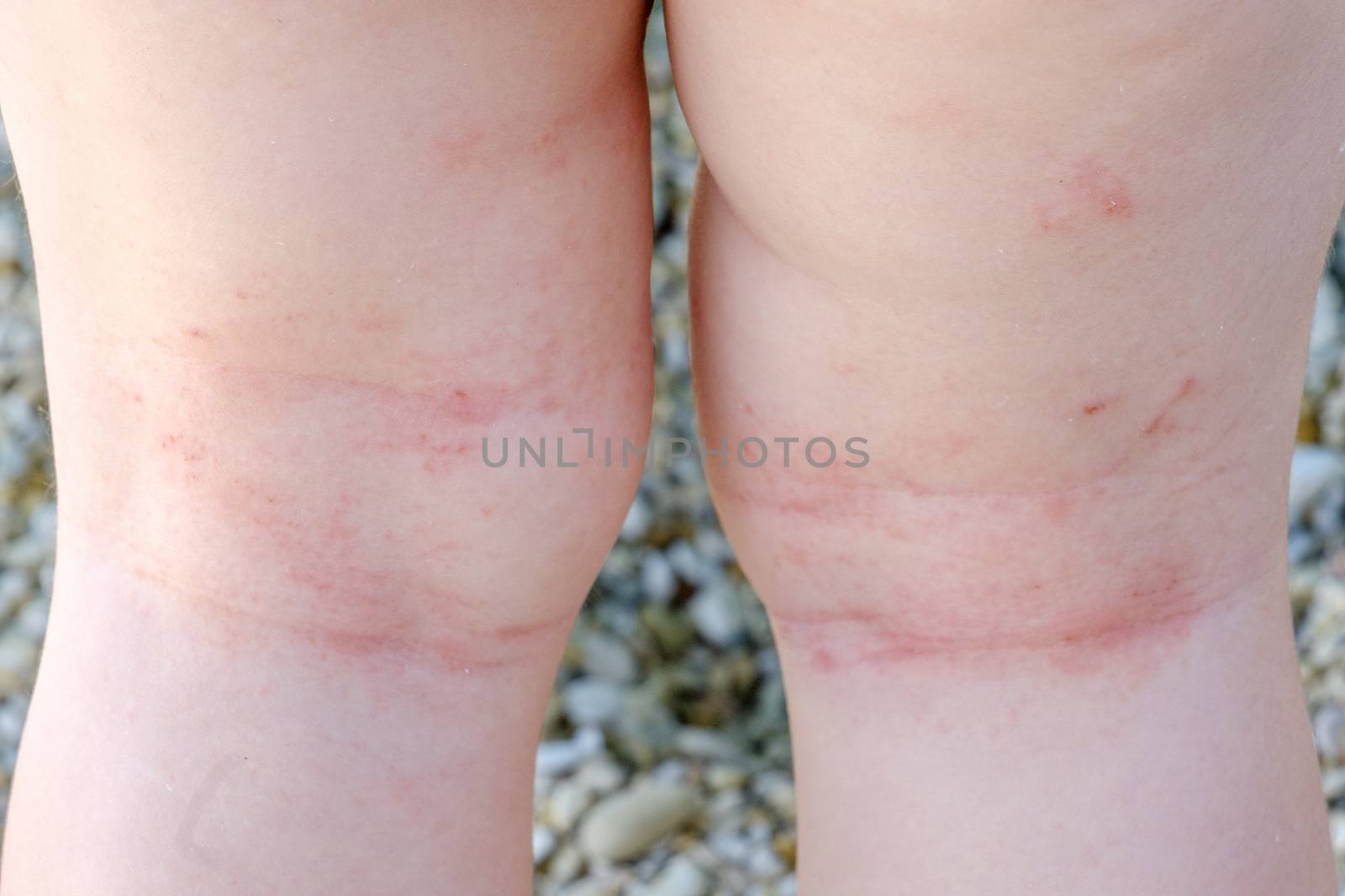 skin irritation newborn closeup atopic dermatitis legs scratches by LucaLorenzelli