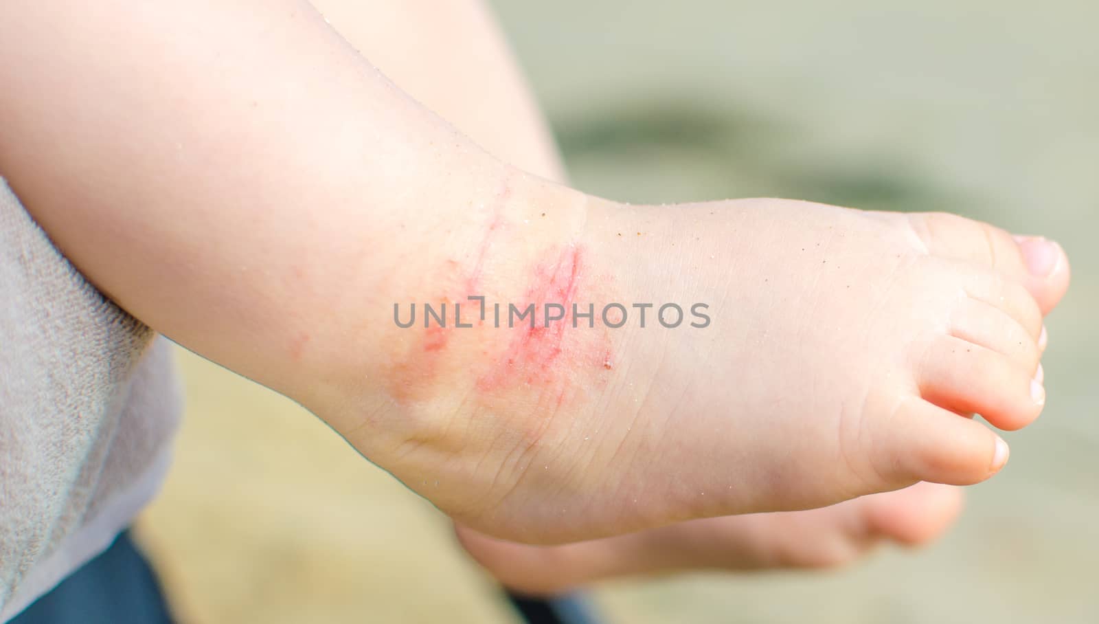 itchy dermatitis atopic baby foot by LucaLorenzelli