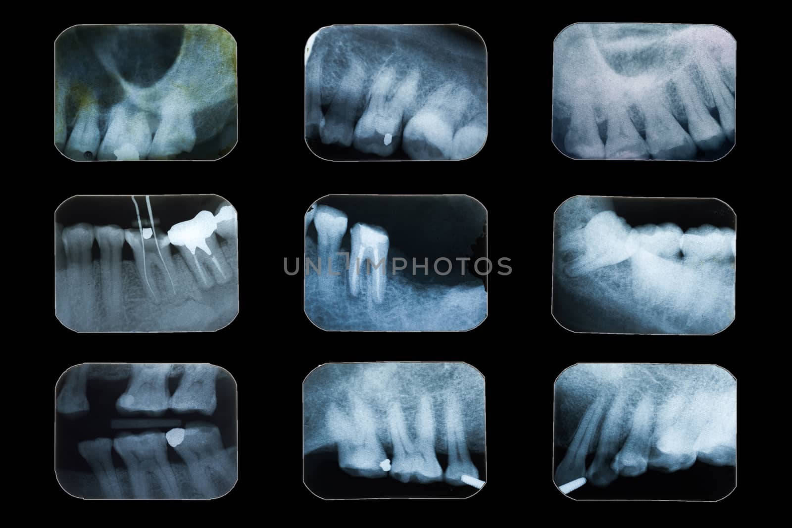 Examination teeth, Multi dental x-ray film on black background. by SaitanSainam