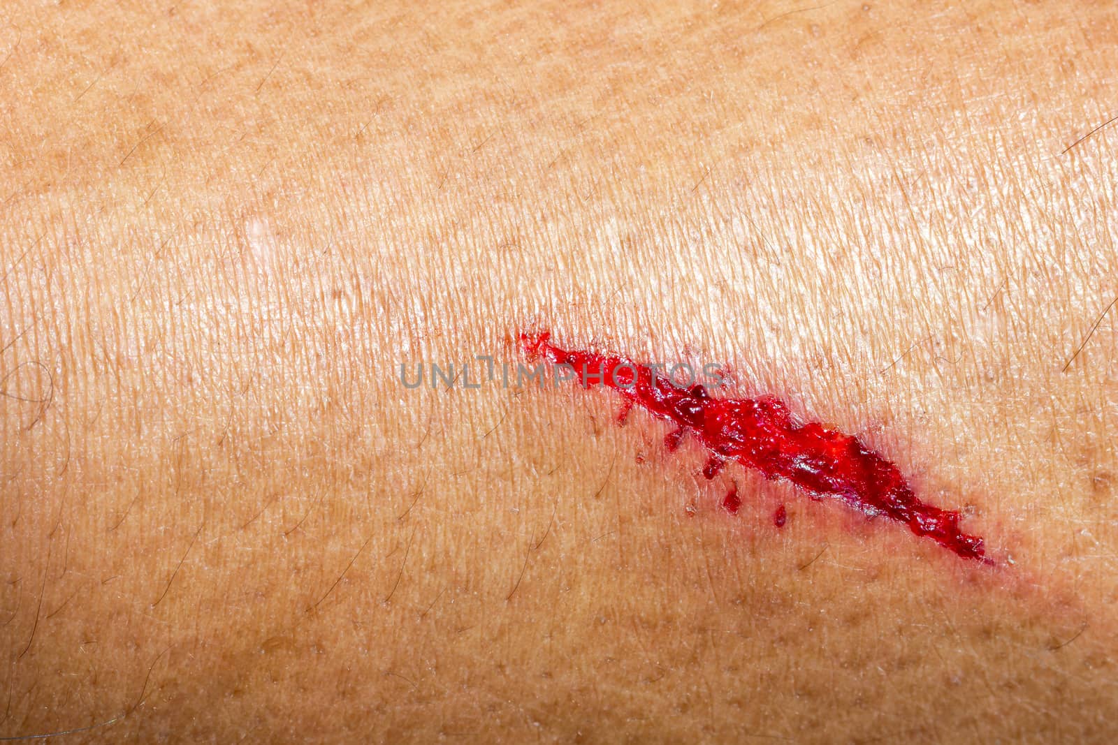 Closeup deep wounds from sharp objects on human skin.