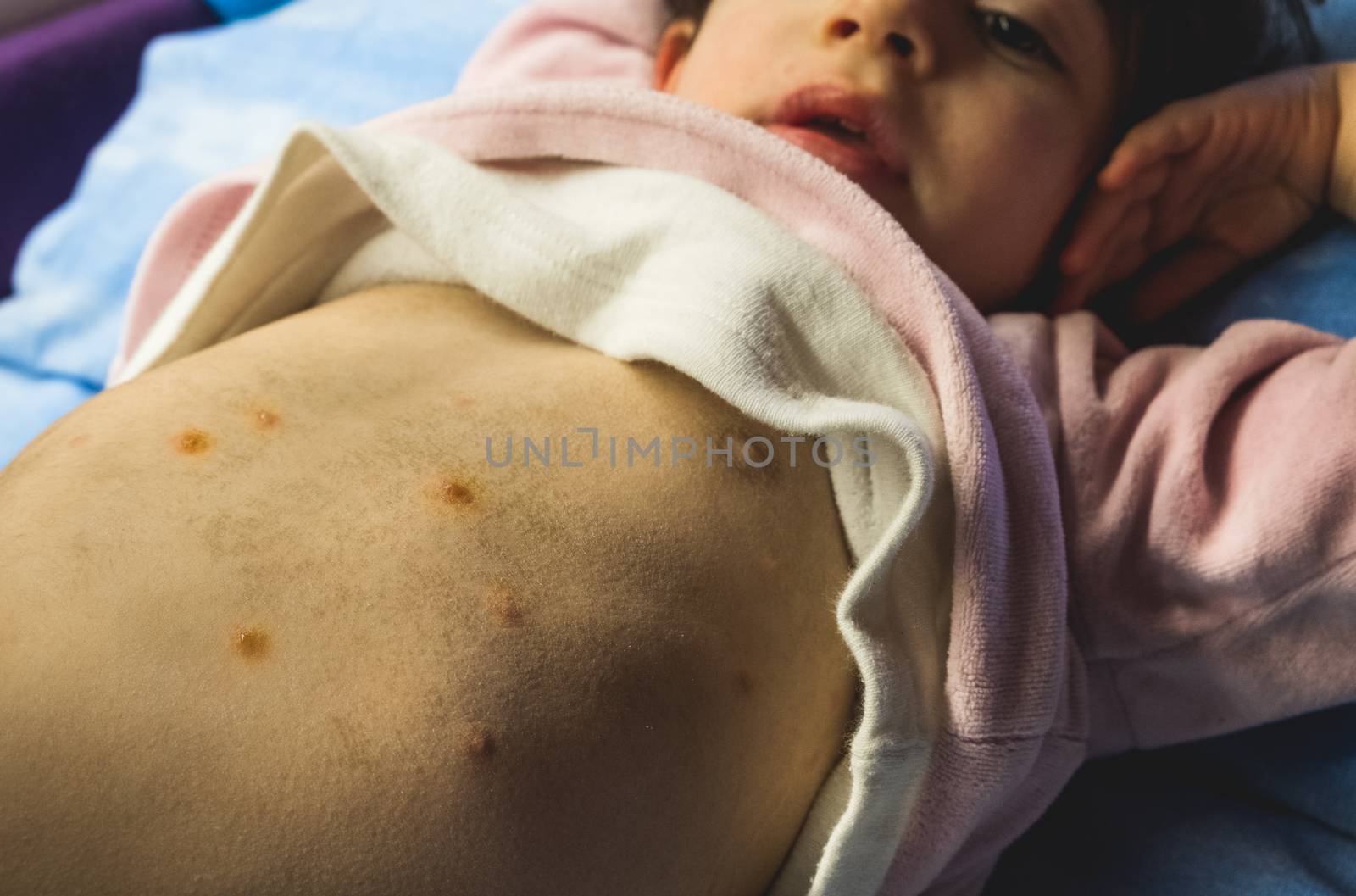 first spots of chicken pox on the baby's tummy by LucaLorenzelli
