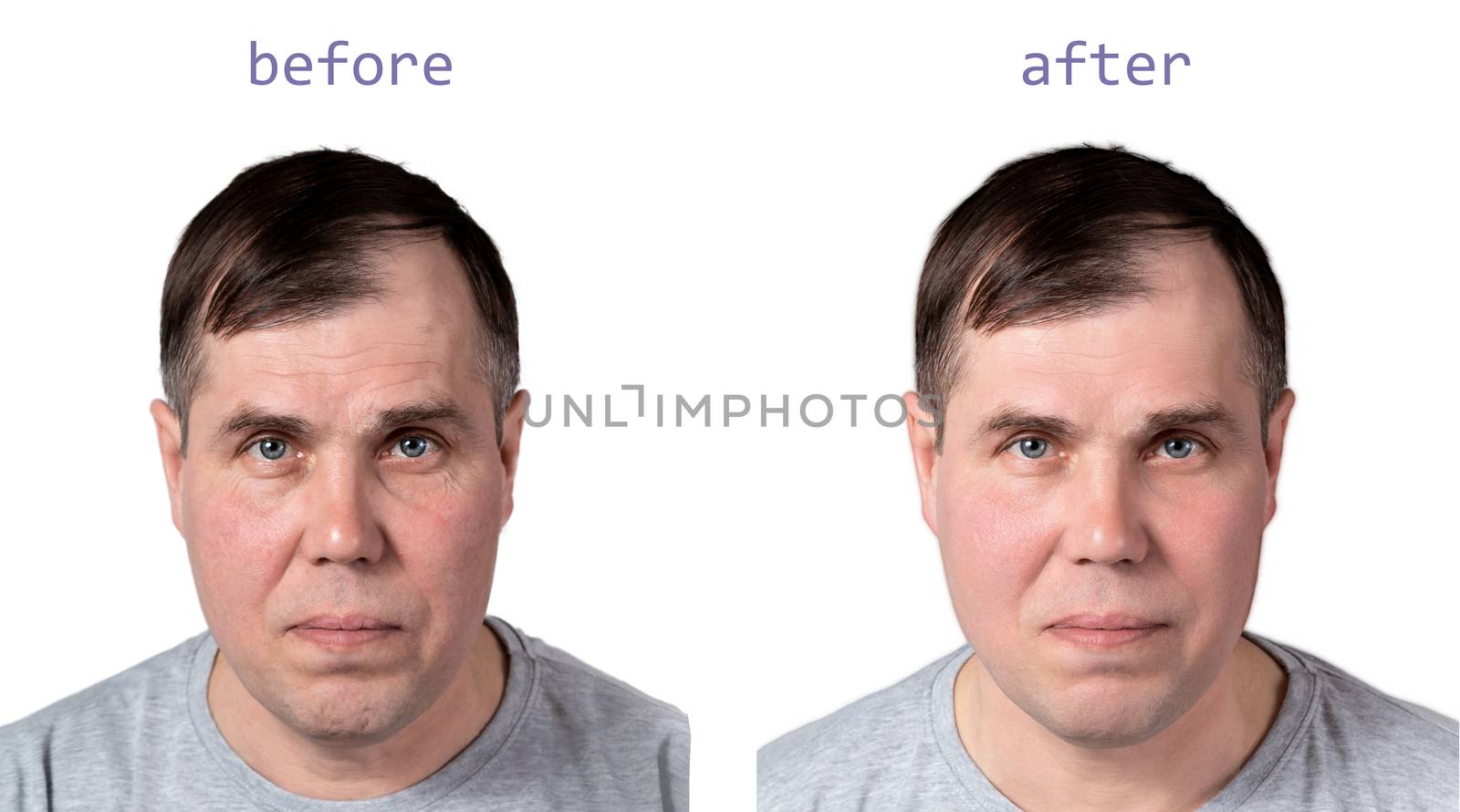 Face of a mature man before and after cosmetic rejuvenating procedures, isolated on white background.