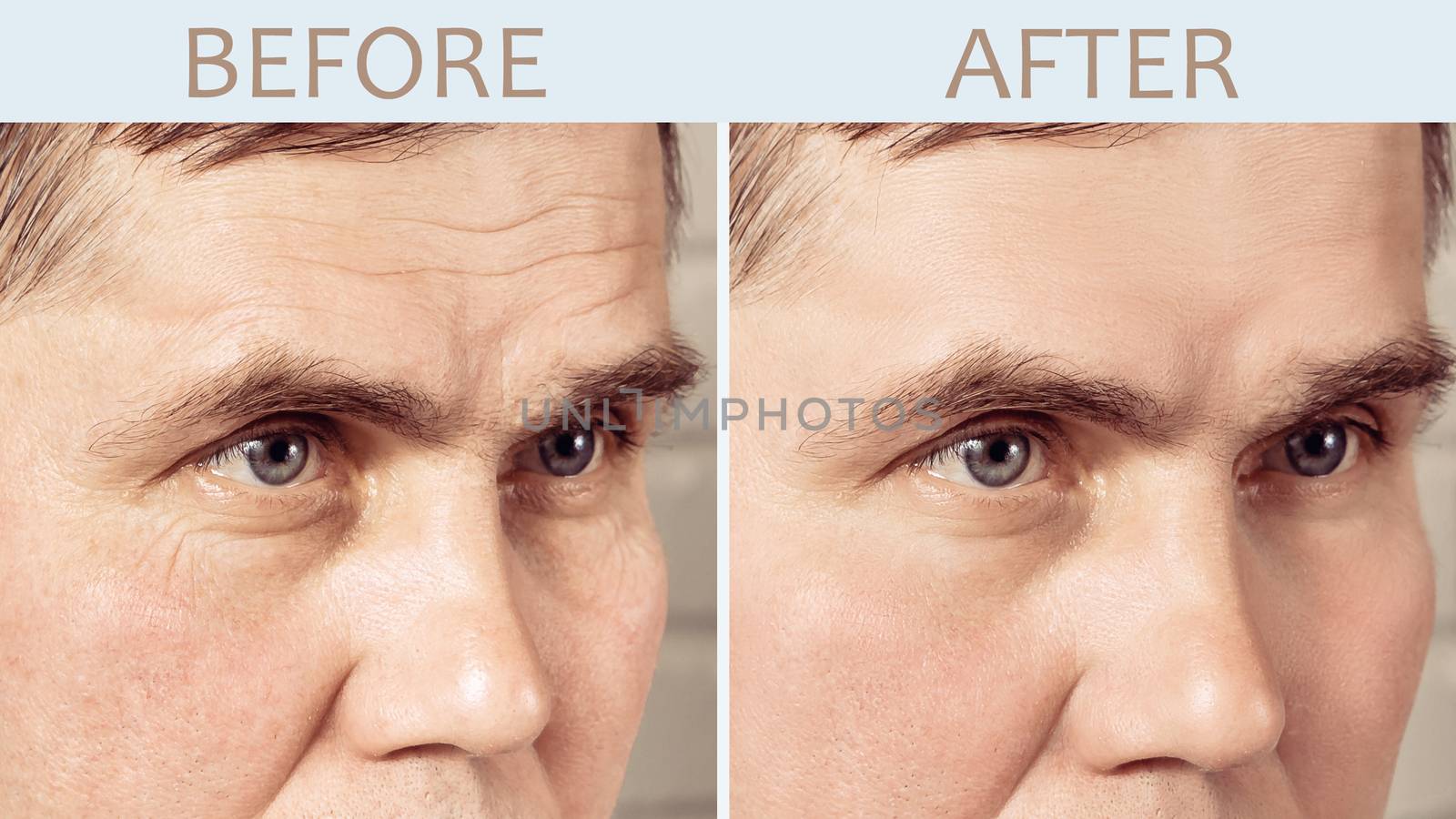 Face of a mature man before and after cosmetic rejuvenating procedures.