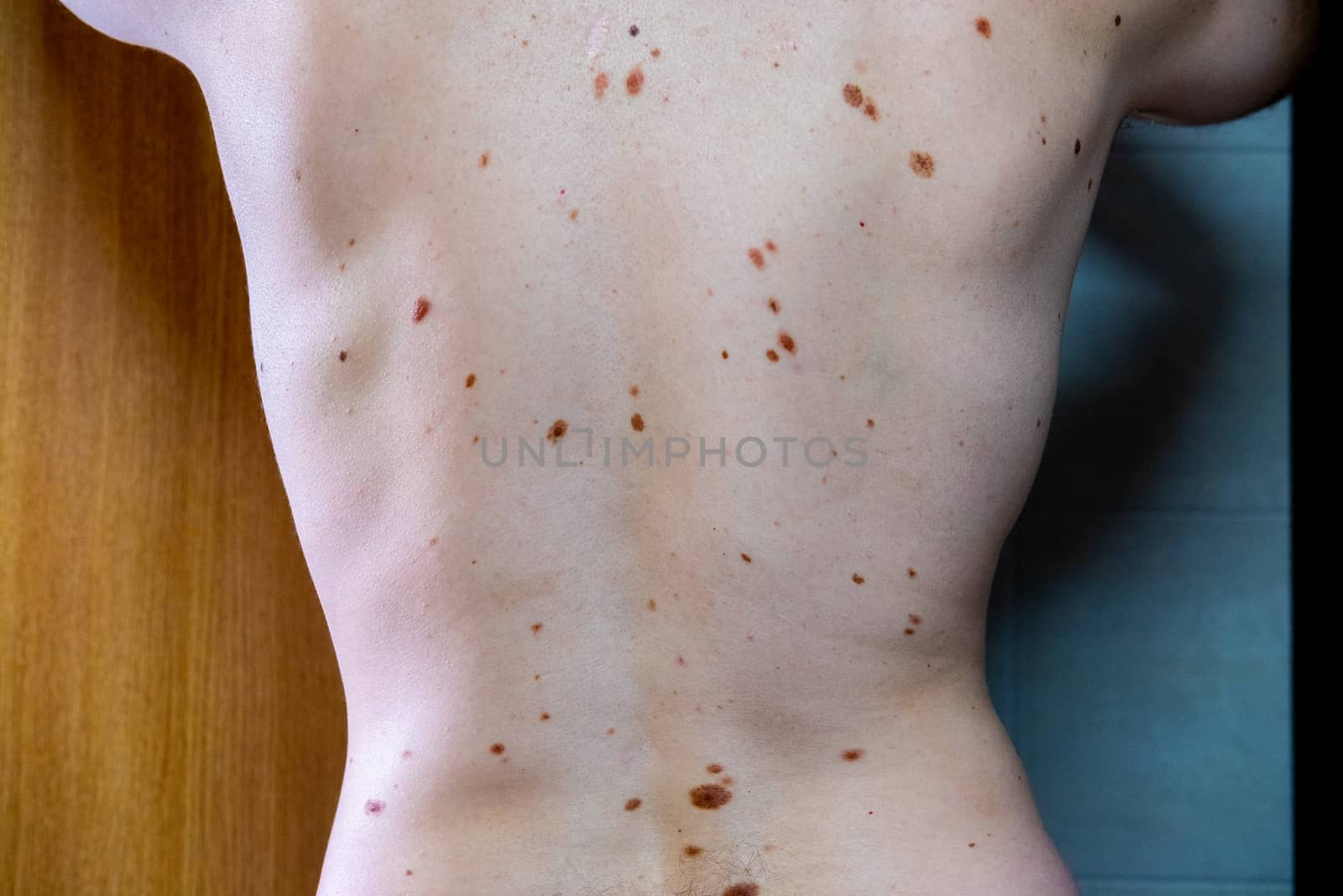Melanocytic nevus, some of them dyplastic or atypical, on a caucasian man of 36 years old by mikelju