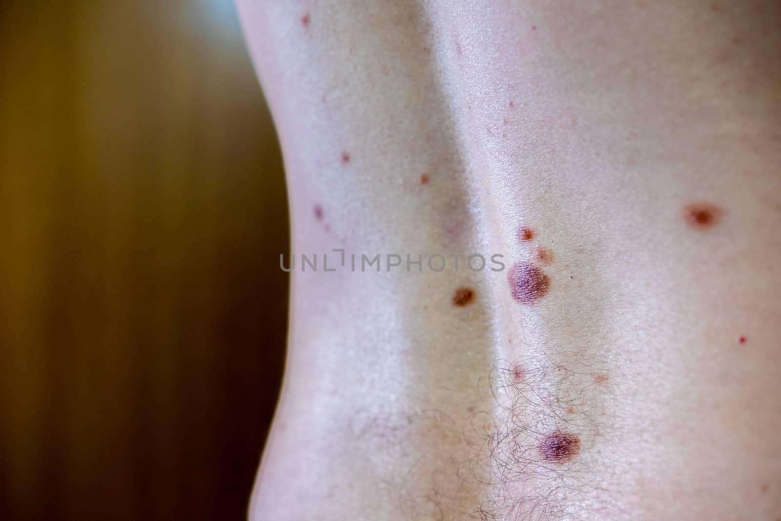 Melanocytic nevus, some of them dyplastic or atypical, on a caucasian man of 36 years old by mikelju