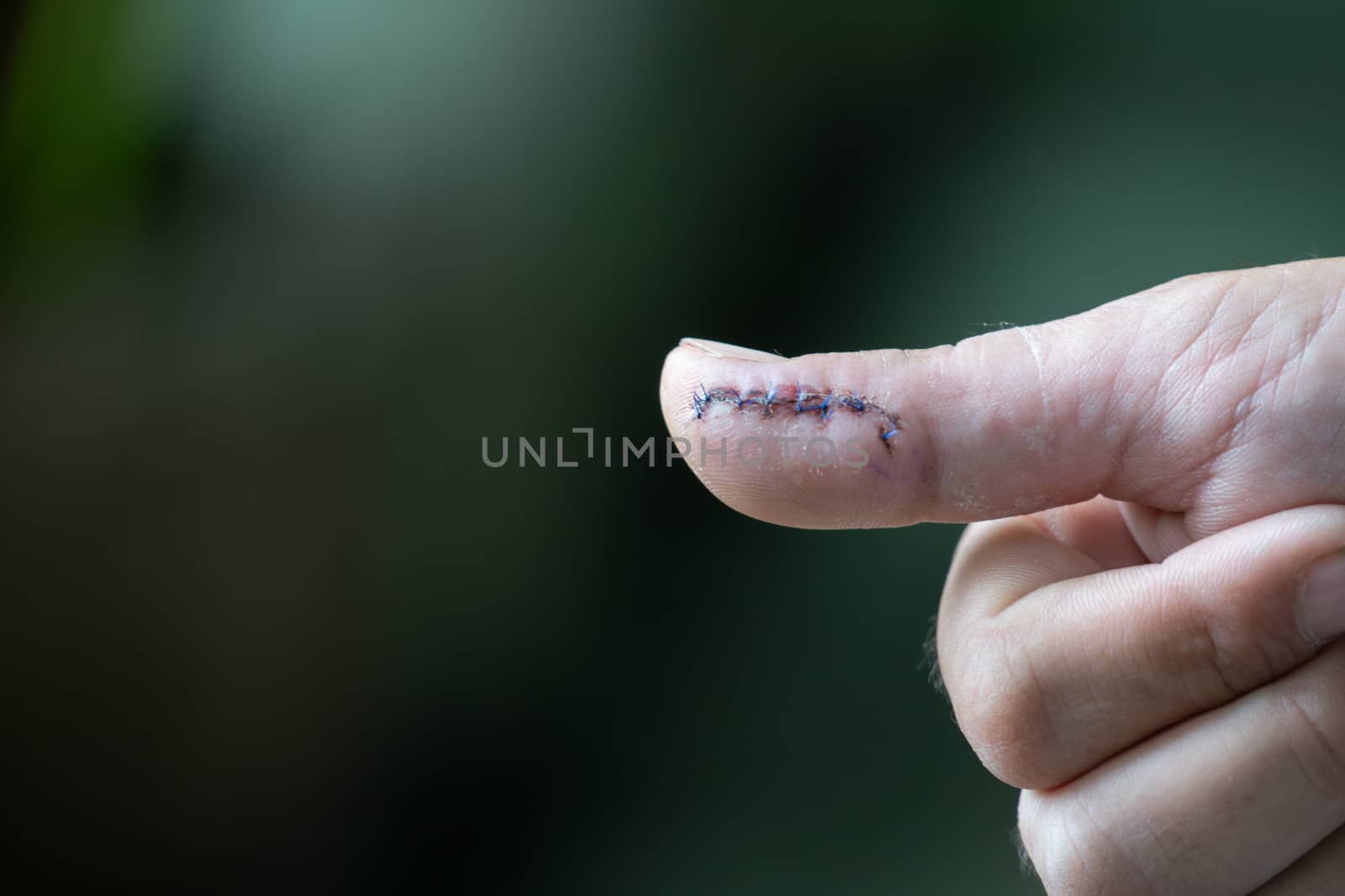 hand with stitches from surgery to repair damage