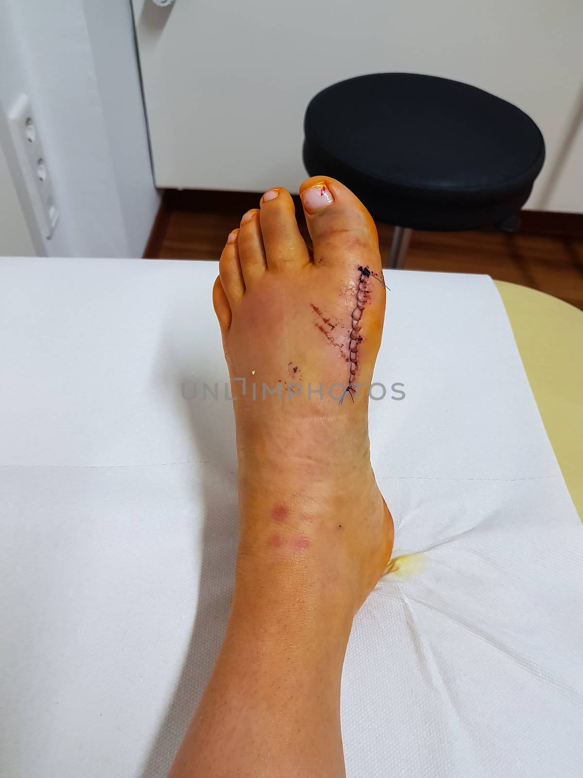 Foot with bloody stings after hallux operation at the first postoperative examination at the doctor for orthopedic surgery