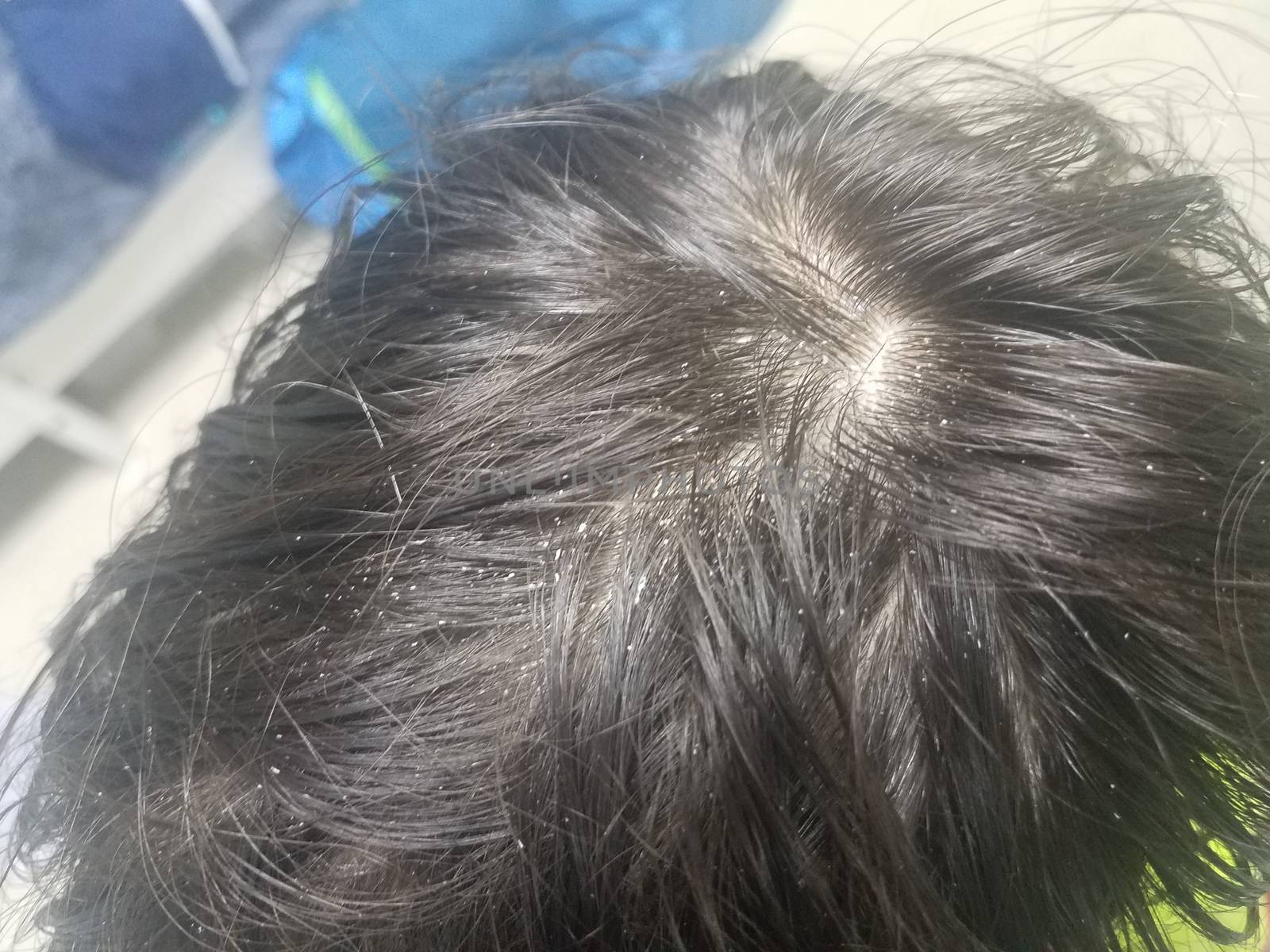 child brown hair with white lice insects or dandruff