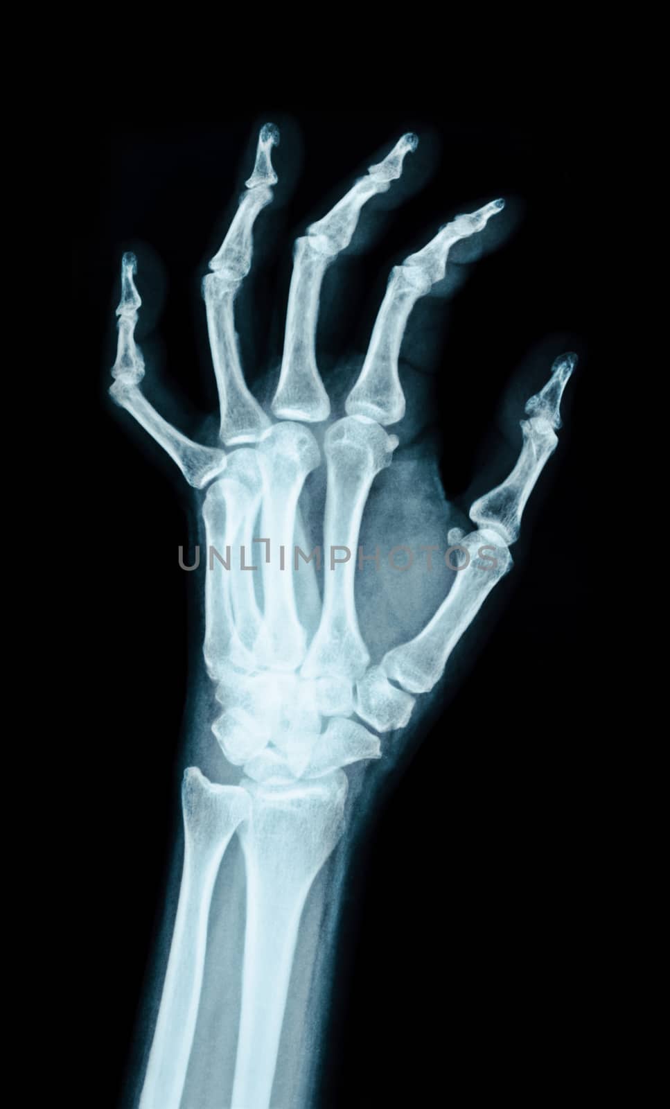 X-ray image of the hand. by Gamjai