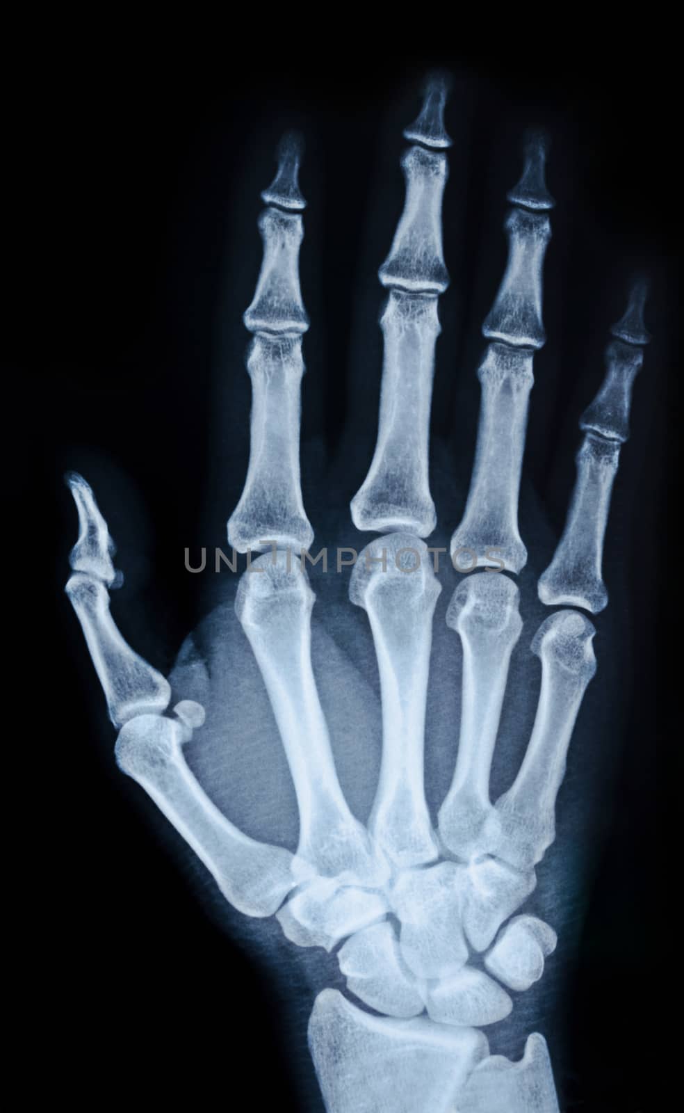 X-ray image of the hand on black background.