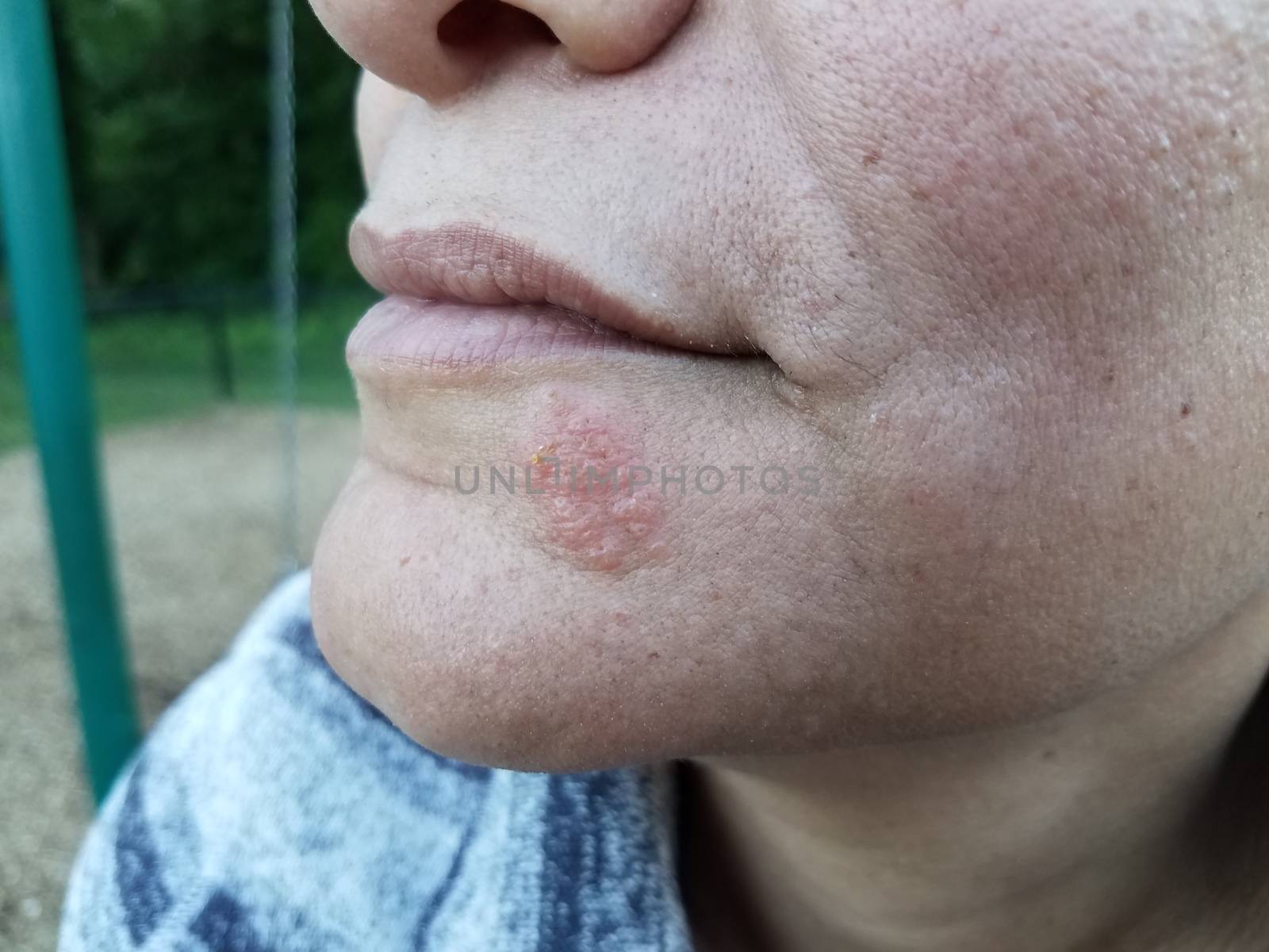 red itchy rash or sore and blister on woman's chin and face