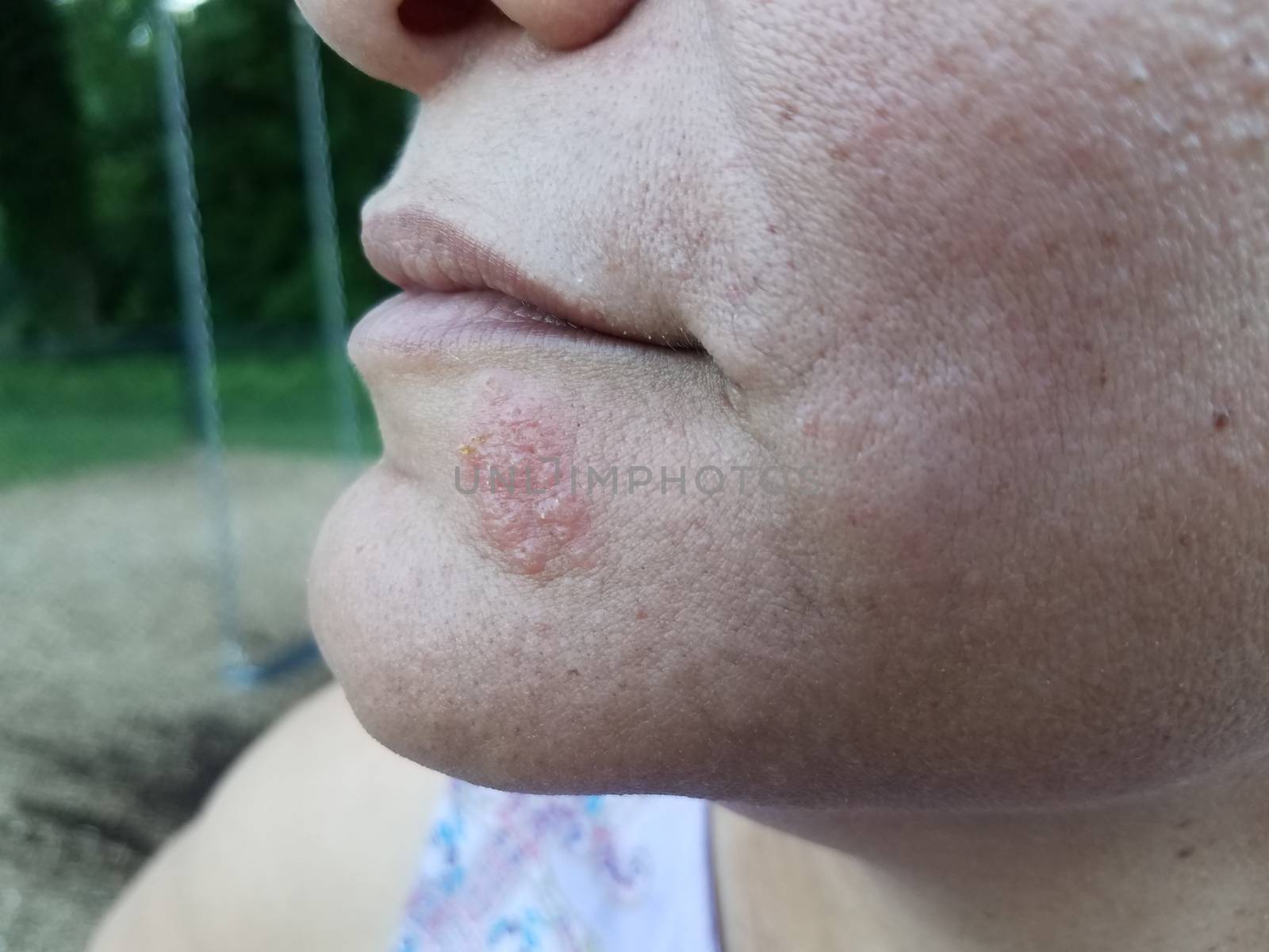 red itchy rash or sore and blister on woman's chin and face