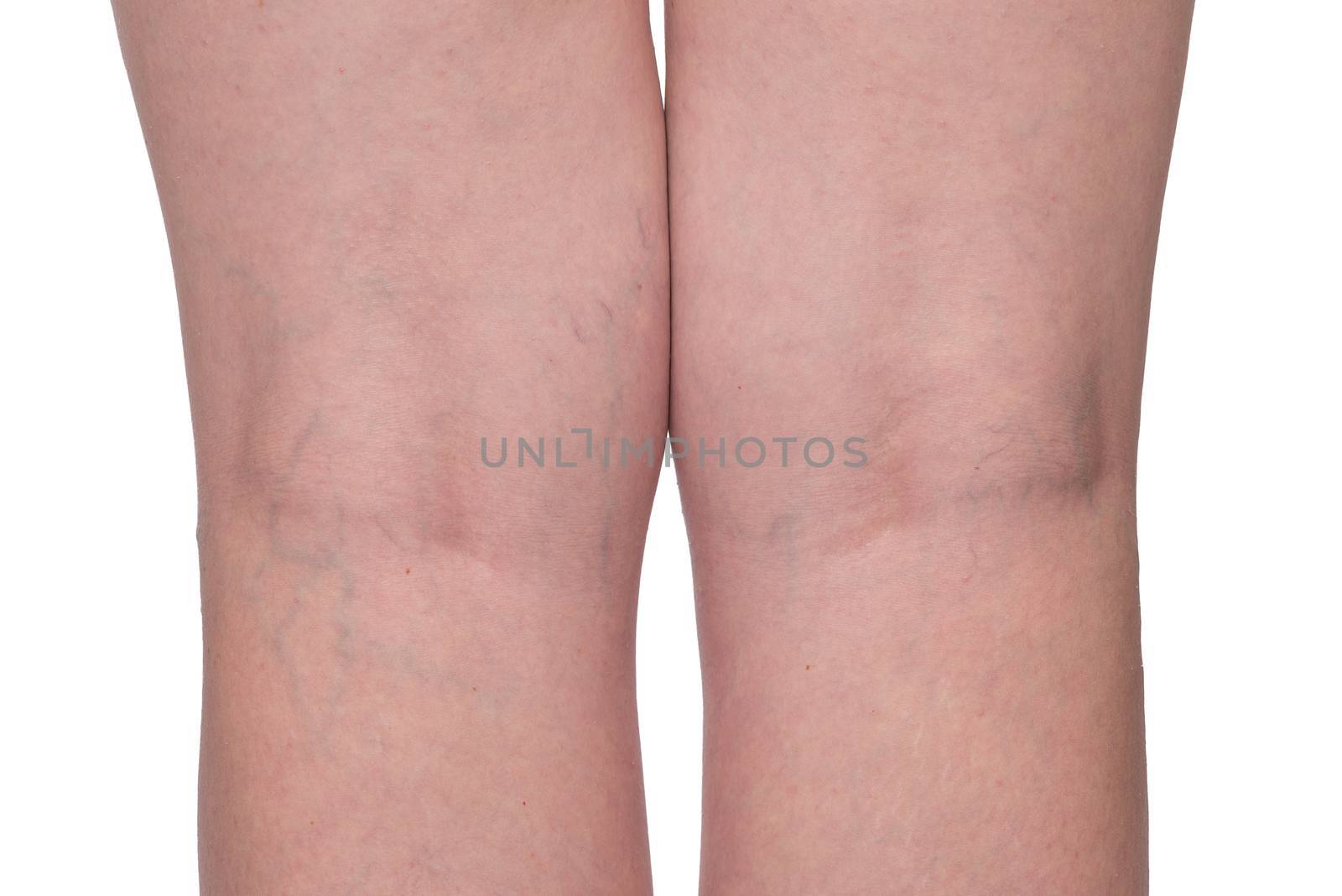 Medical problem - varicose veins, female legs close up on a white background