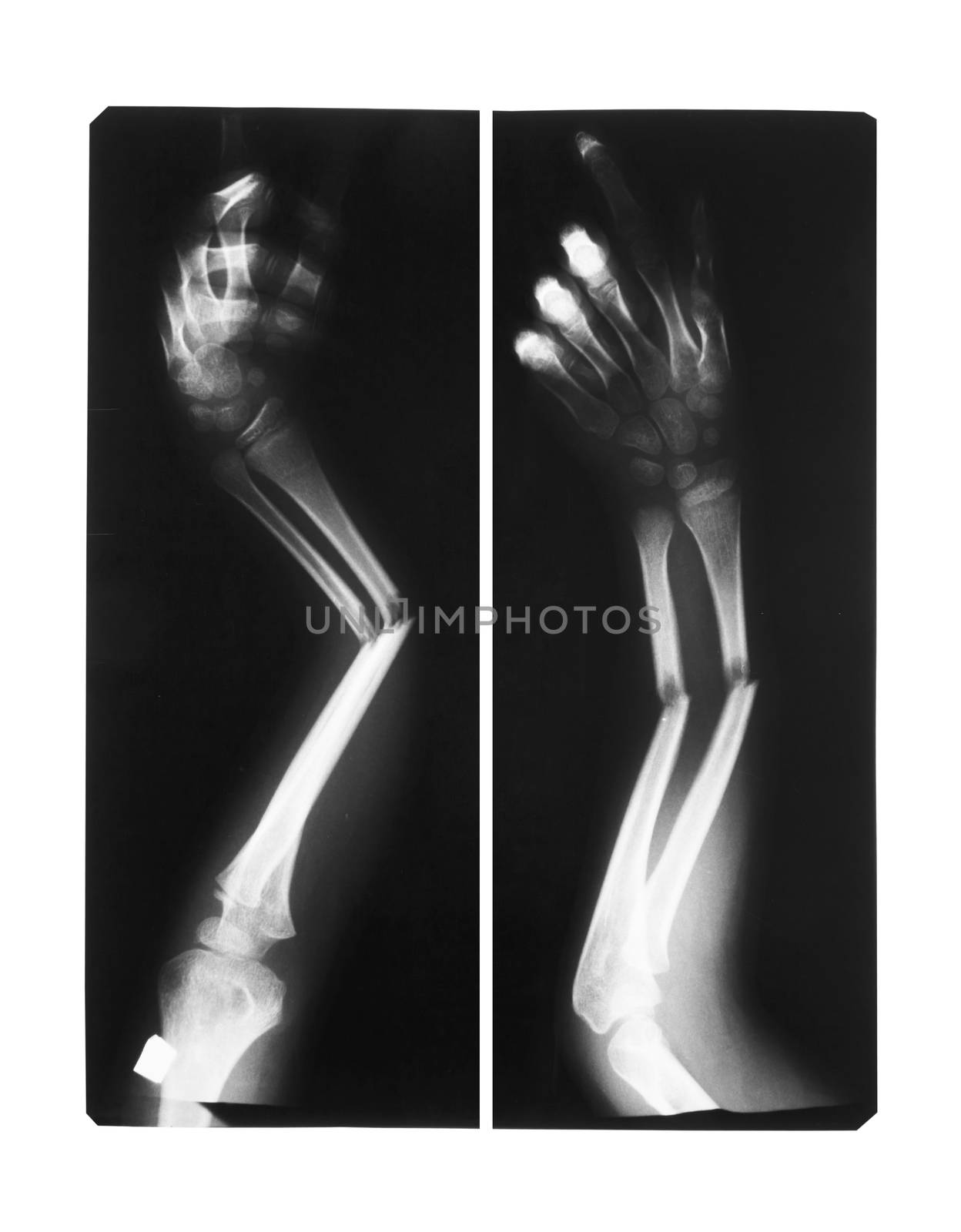 film x-ray forearm AP : show double fracture shaft of ulnarorforearm's bone