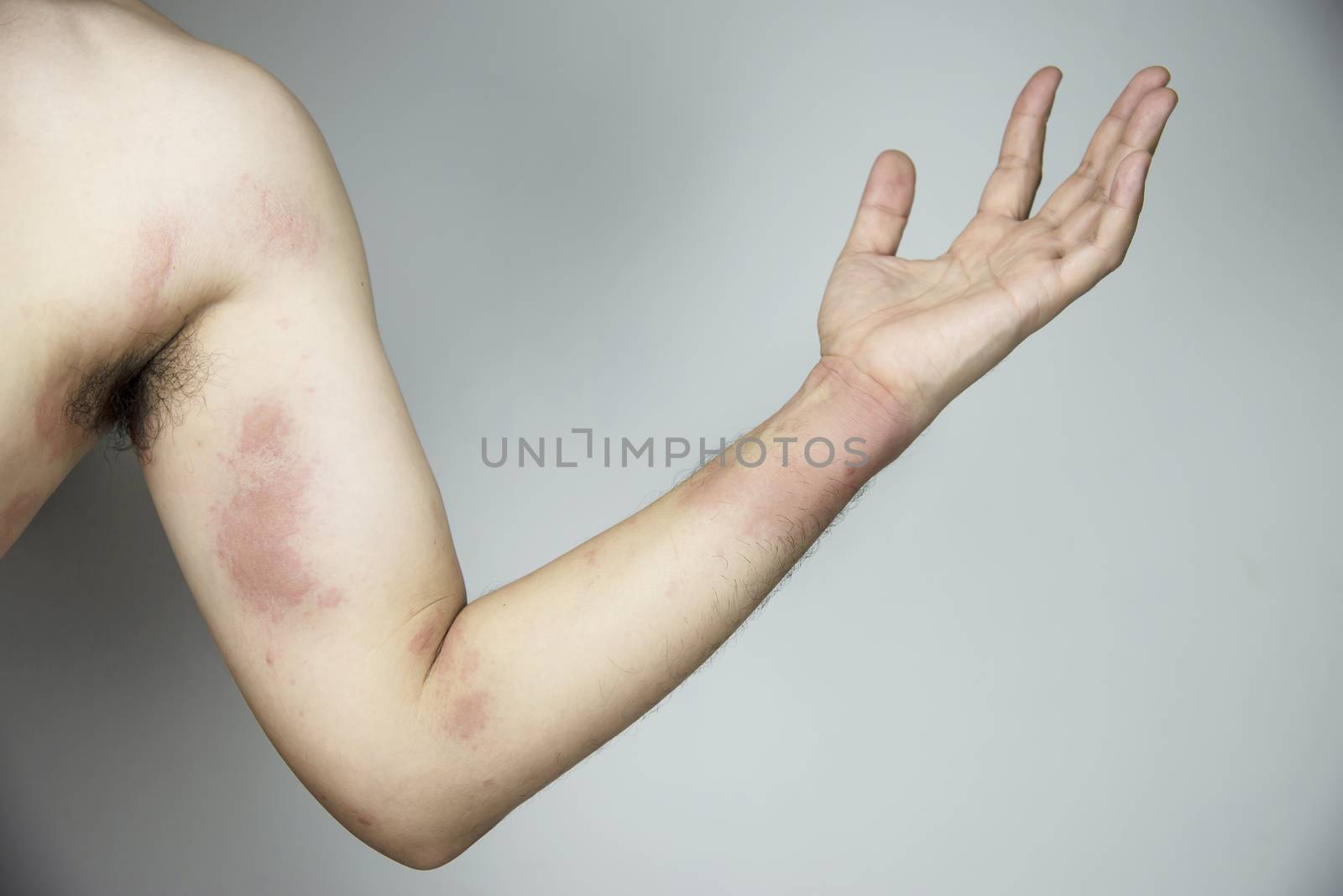 Man getting red skin rash at his body part by pairhandmade