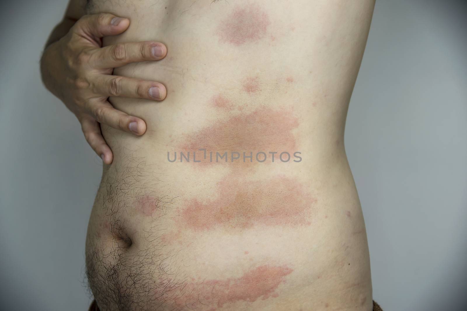 Man getting red skin rash at his body part - people with skin allergy problem concept by pairhandmade