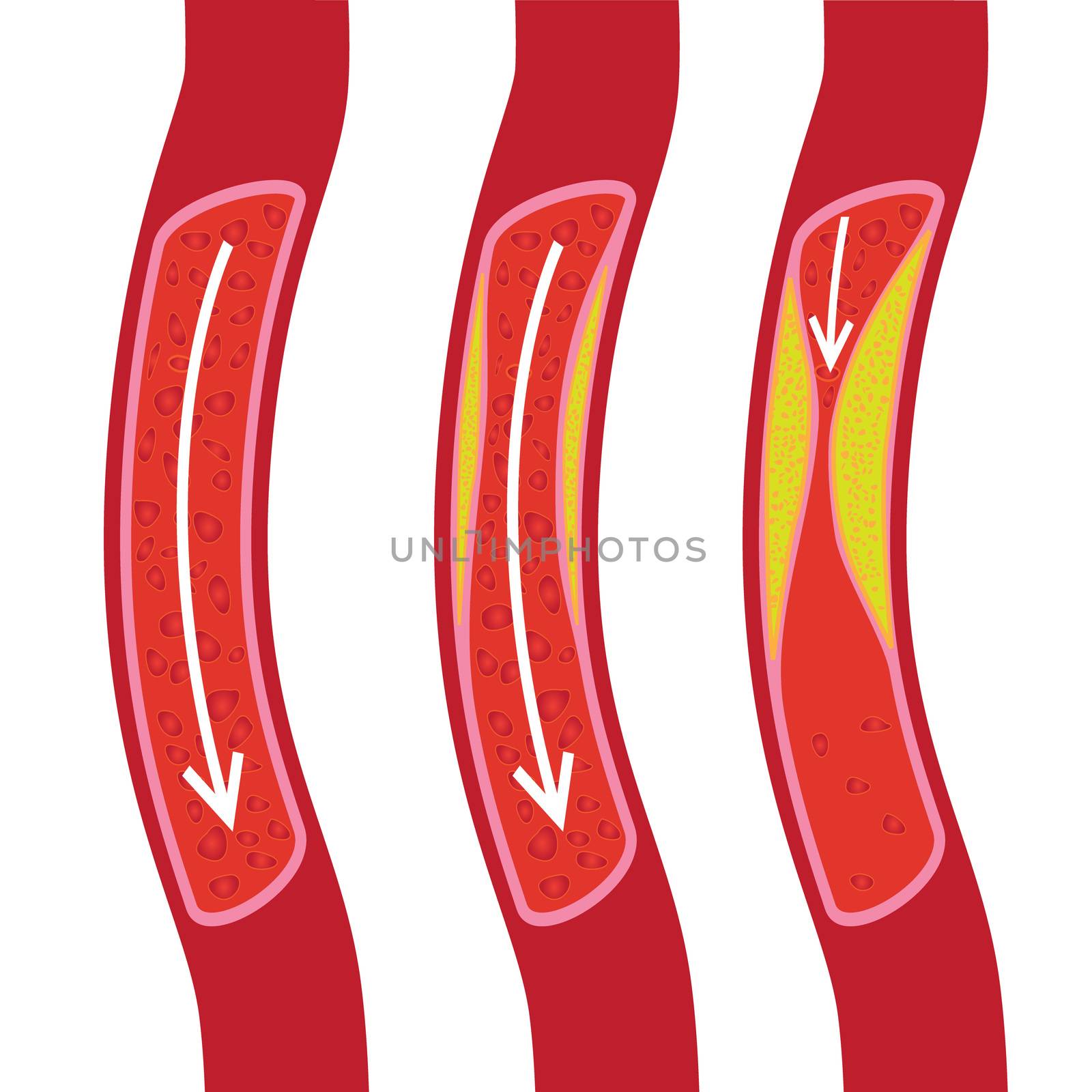Healthy, partly blocked blood vessel and blocked blood vessel illustration. plaque