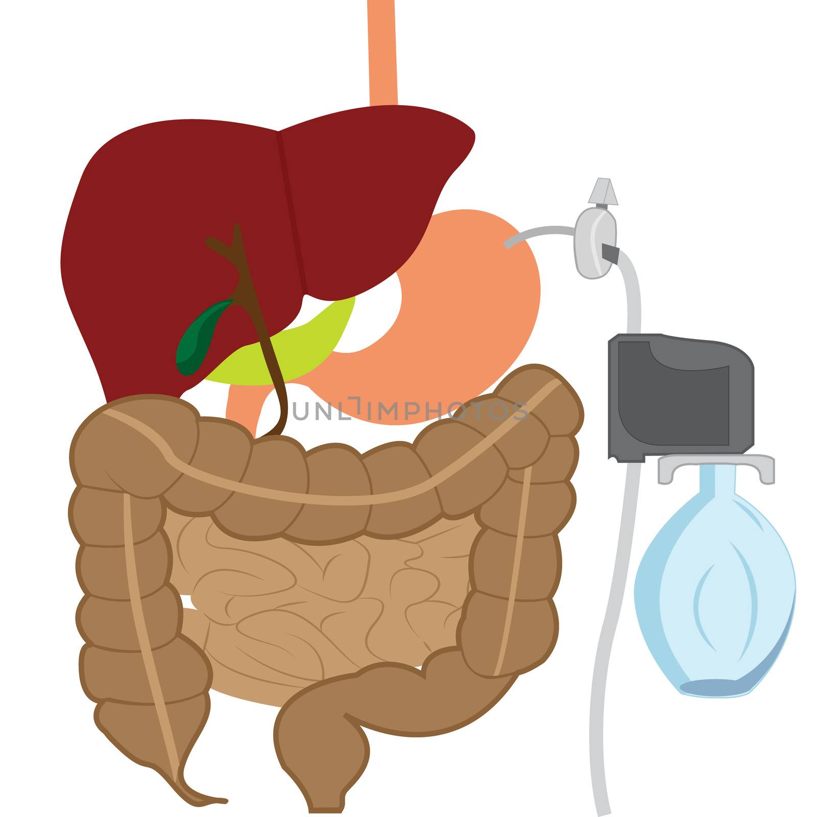 Aspire Assist for lose weight therapy vector illustration