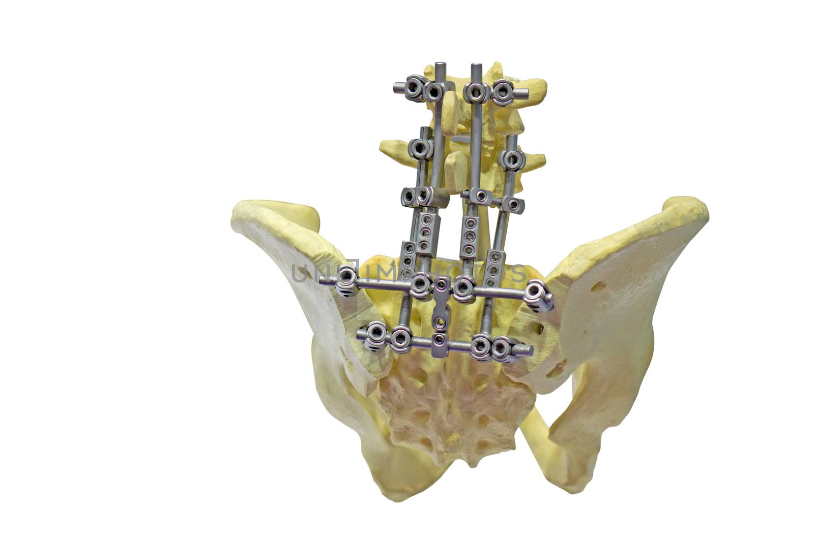 Repair of the pelvis or hip joint using an iron splint. by pkproject