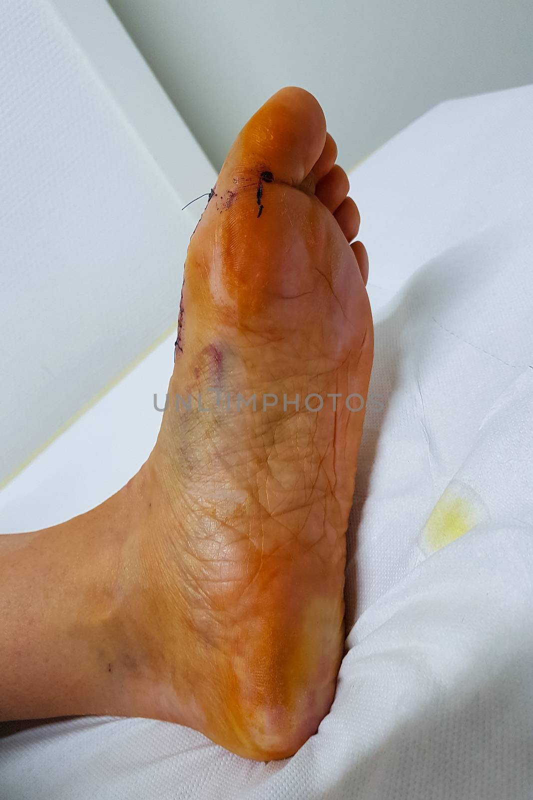 Foot with bloody stings after hallux operation at the first postoperative examination at the doctor for orthopedic surgery