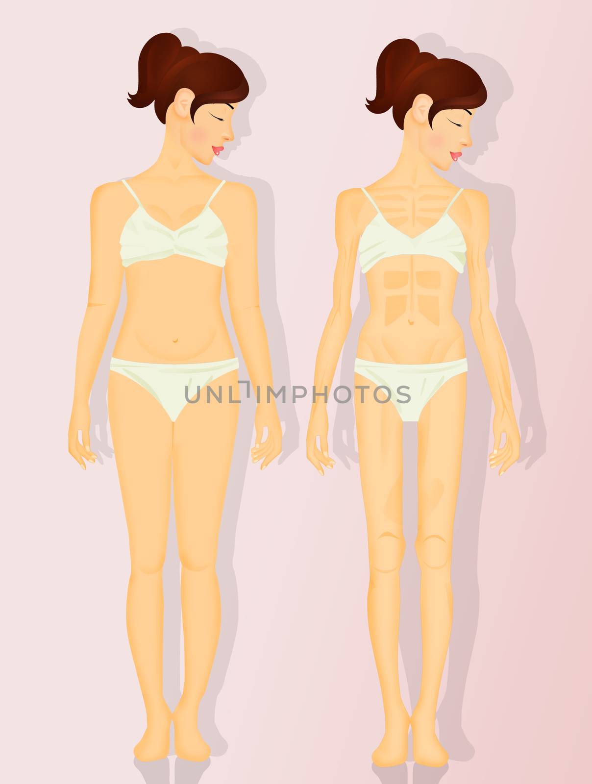 illustration of anorexia