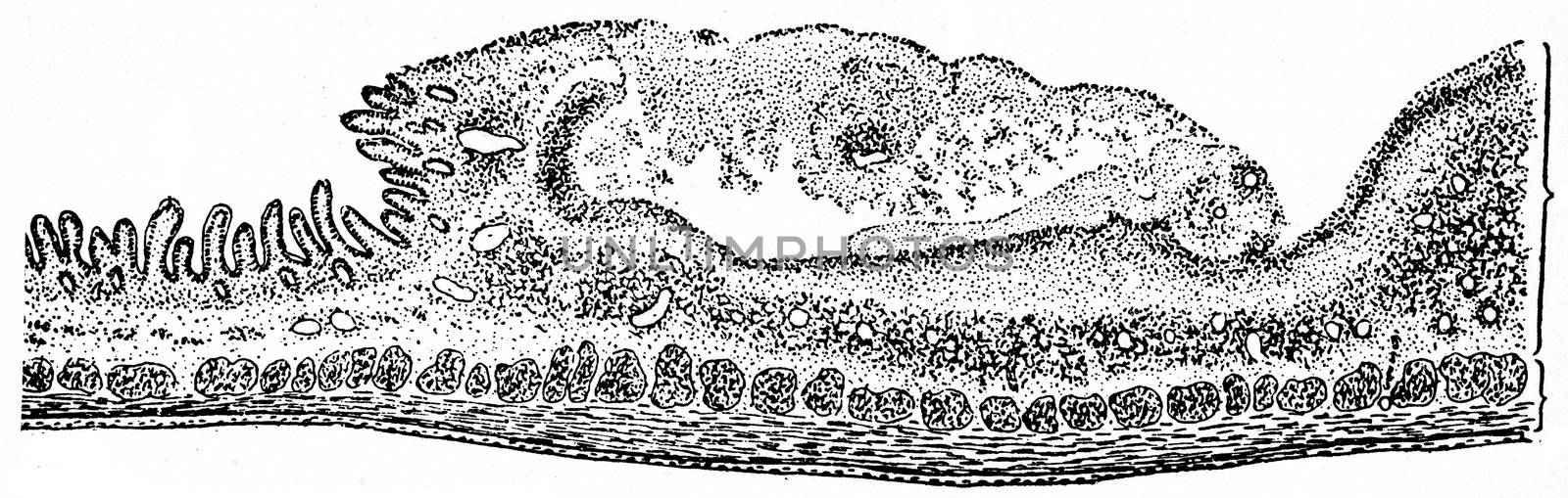 Section through a typhoid ulcer, end of second week of the disease, vintage engraved illustration.
