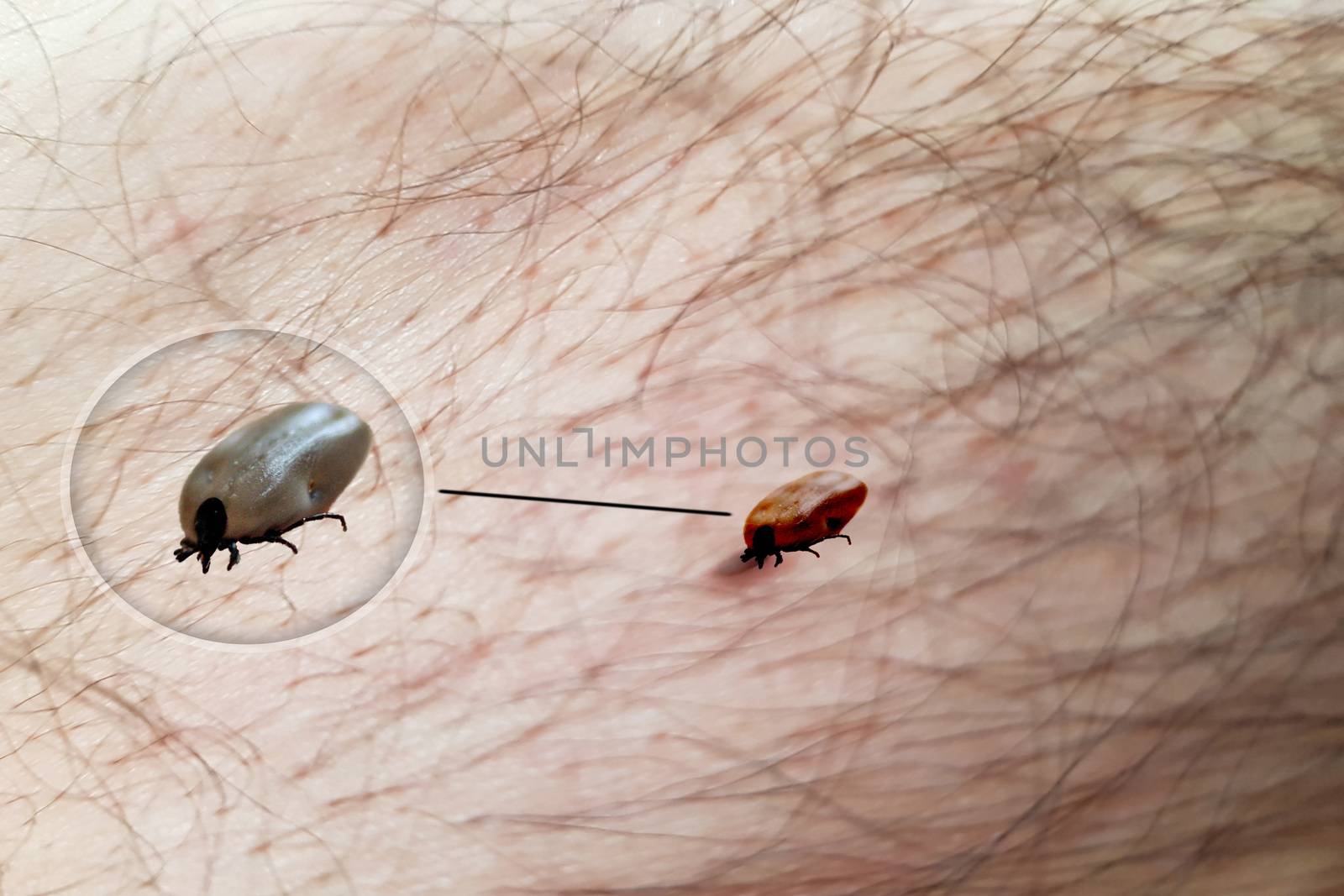 Tick crawls on the skin. Walking over the human body. The tick transmits encephalitis, Lyme disease, babesiosis and ehrlichiosis.