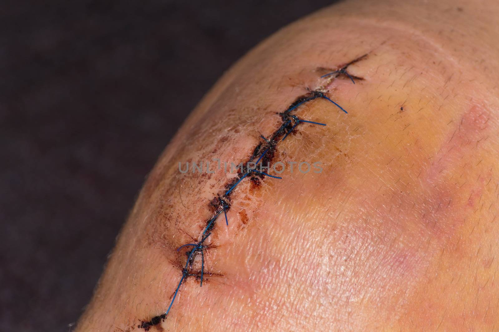 Male knee after surgical operation, knee replacement. Knee surgery in the hospital
