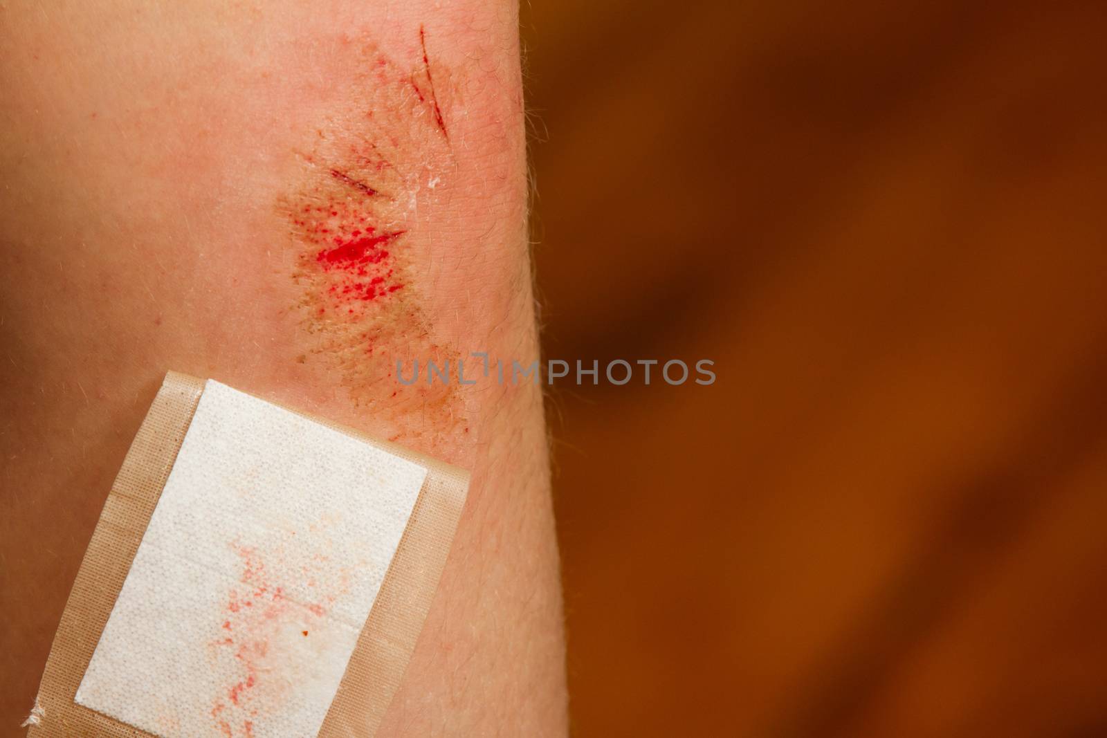 Young girl fell while riding a bike causing a large abrasion to her knee that she bandaged up