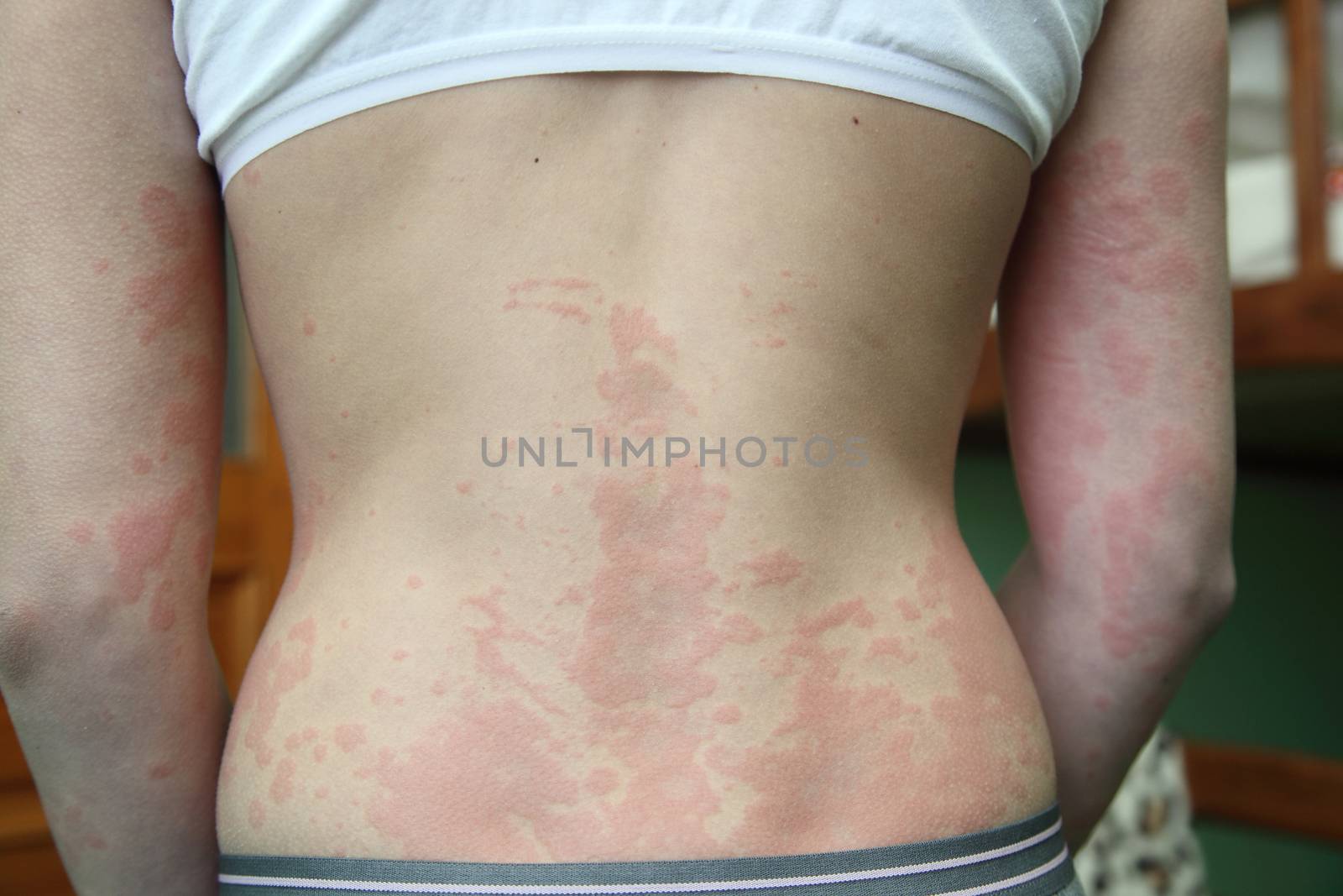 allergic dermatitis. The skin of the girl's back is amazed by dermatitis