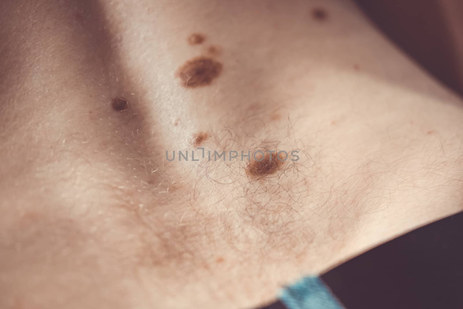 Melanocytic nevus, some of them dyplastic or atypical, on a caucasian man of 37 years old from Spain by mikelju