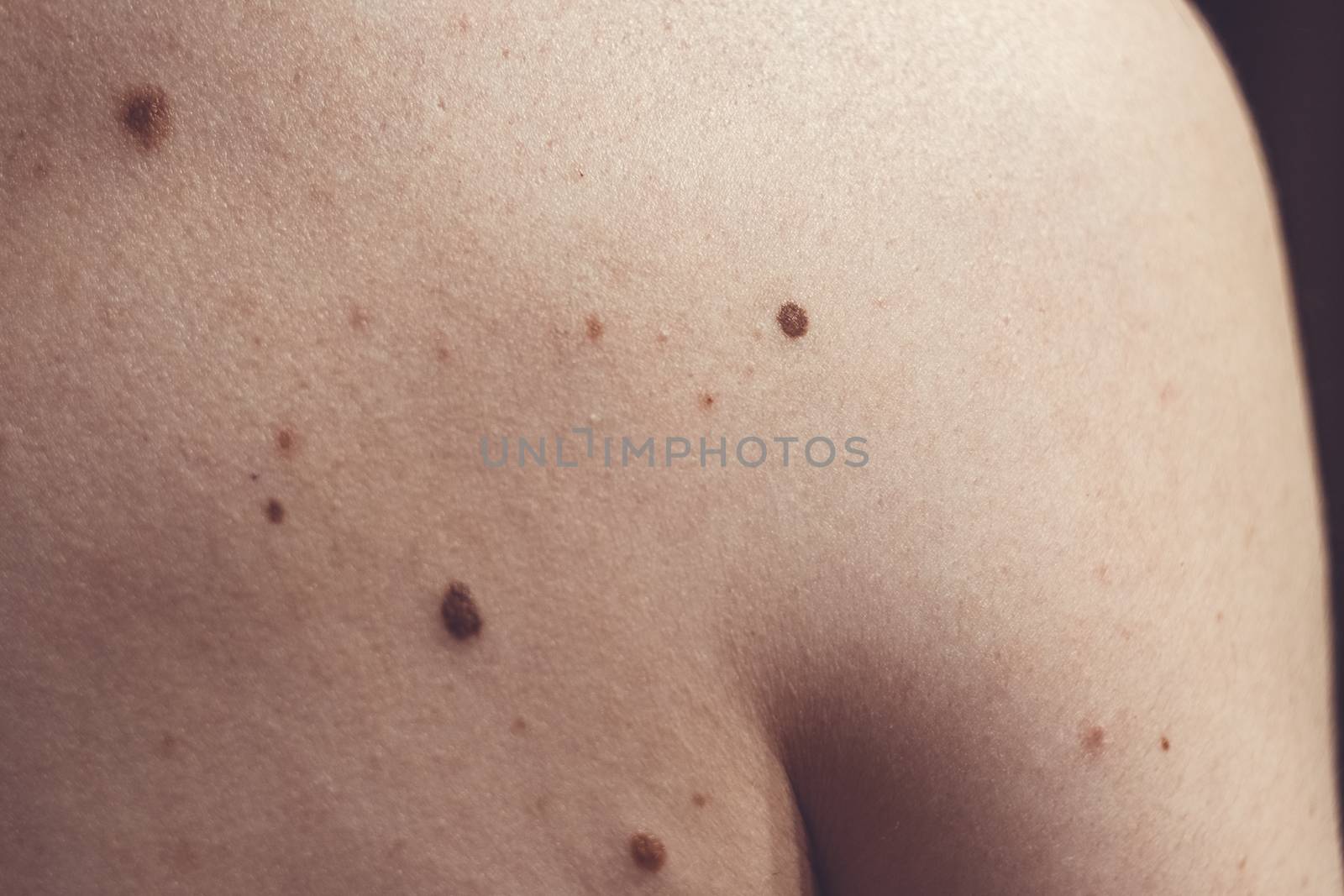 A melanocytic nevus also known as nevocytic or nevus-cell nevus and commonly as a mole is a type of melanocytic tumor