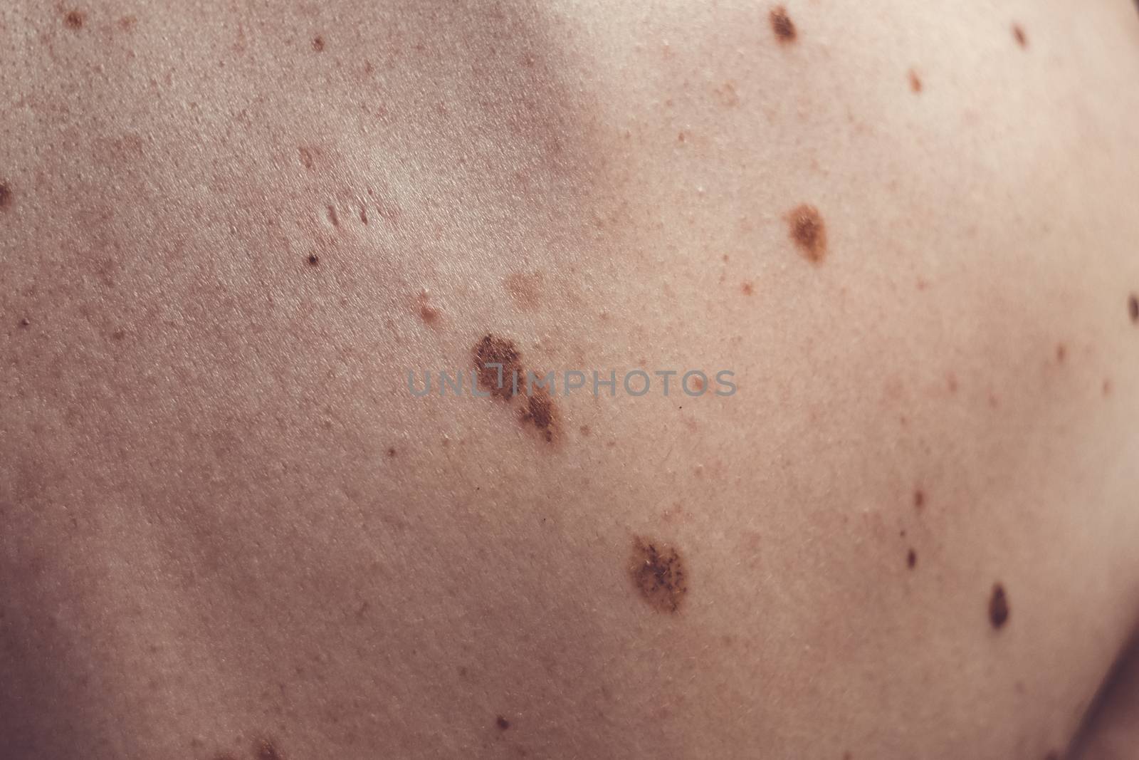 Melanocytic nevus, some of them dyplastic or atypical, on a caucasian man of 37 years old from Spain by mikelju