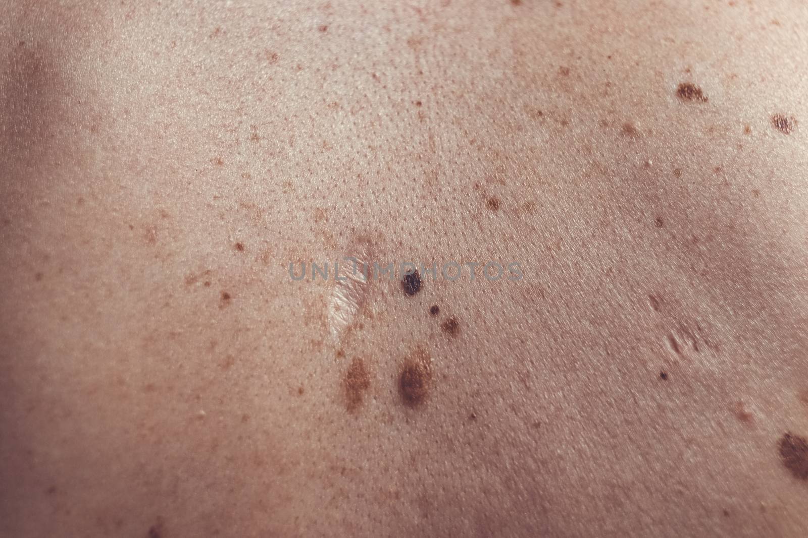 A melanocytic nevus also known as nevocytic or nevus-cell nevus and commonly as a mole is a type of melanocytic tumor