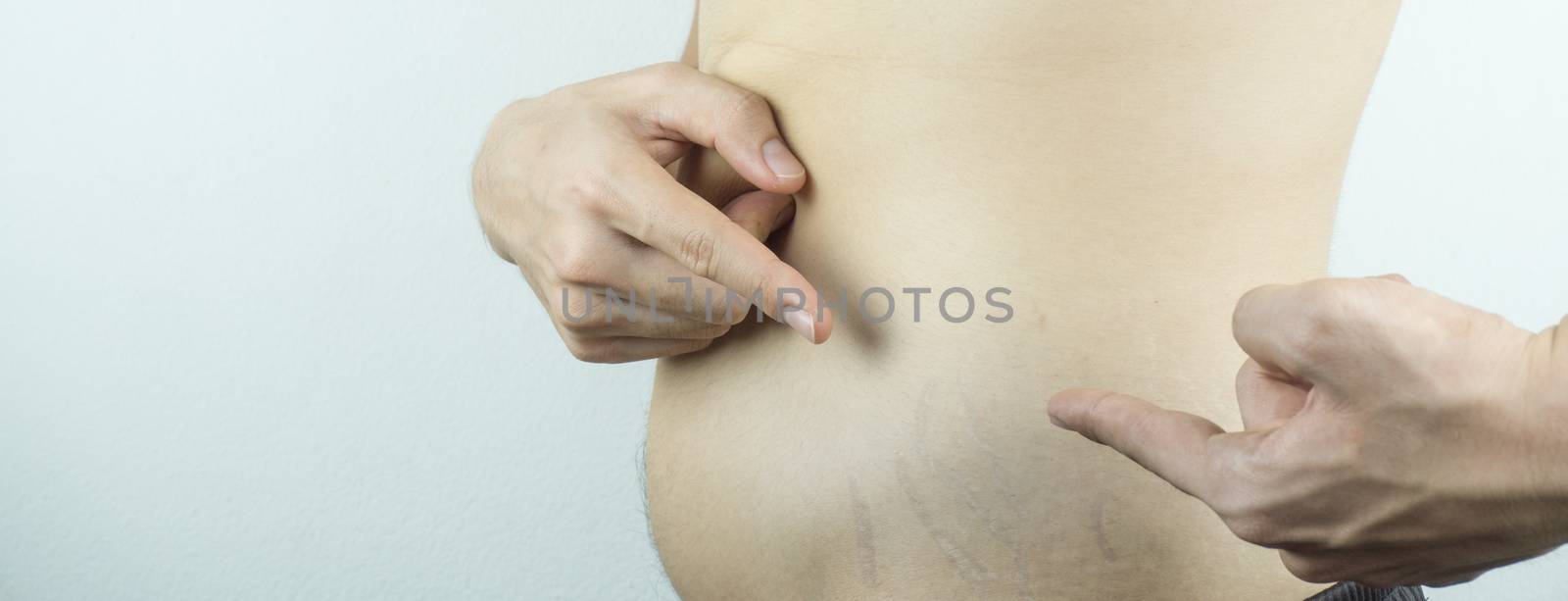 Man showing and pointing to the belly with stretch marks on whit by mikesaran