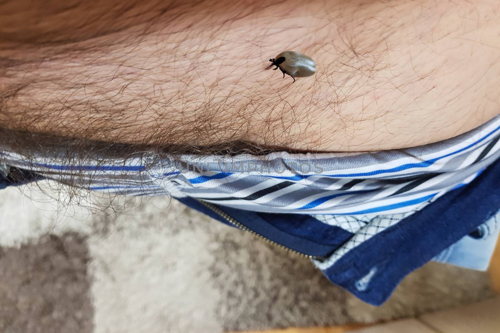 Tick, Ixodes ricinus on human skin in the genital area. Walking over the human body. Encephalitis tick, this type of animal is a spreader of Borrelia and Tbe.