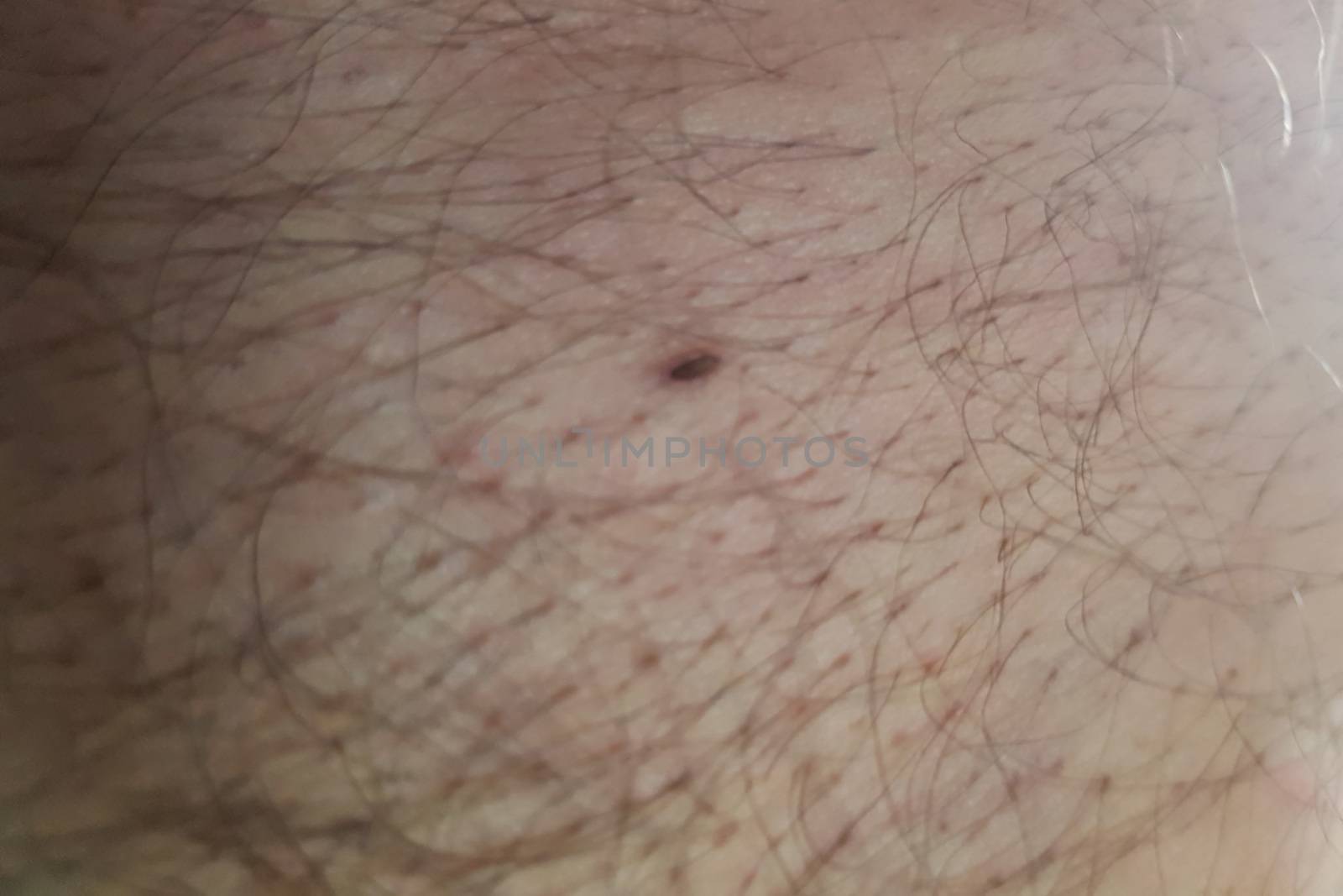 Tick crawls on the skin. Walking over the human body. The tick transmits encephalitis, Lyme disease, babesiosis and ehrlichiosis.