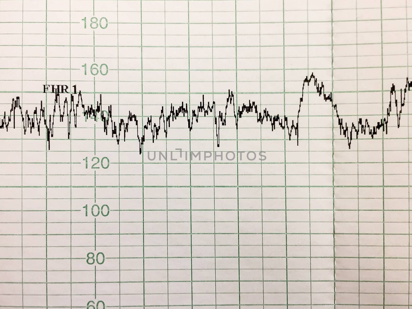 Printing of cardiogram report, electrocardiography, close-up