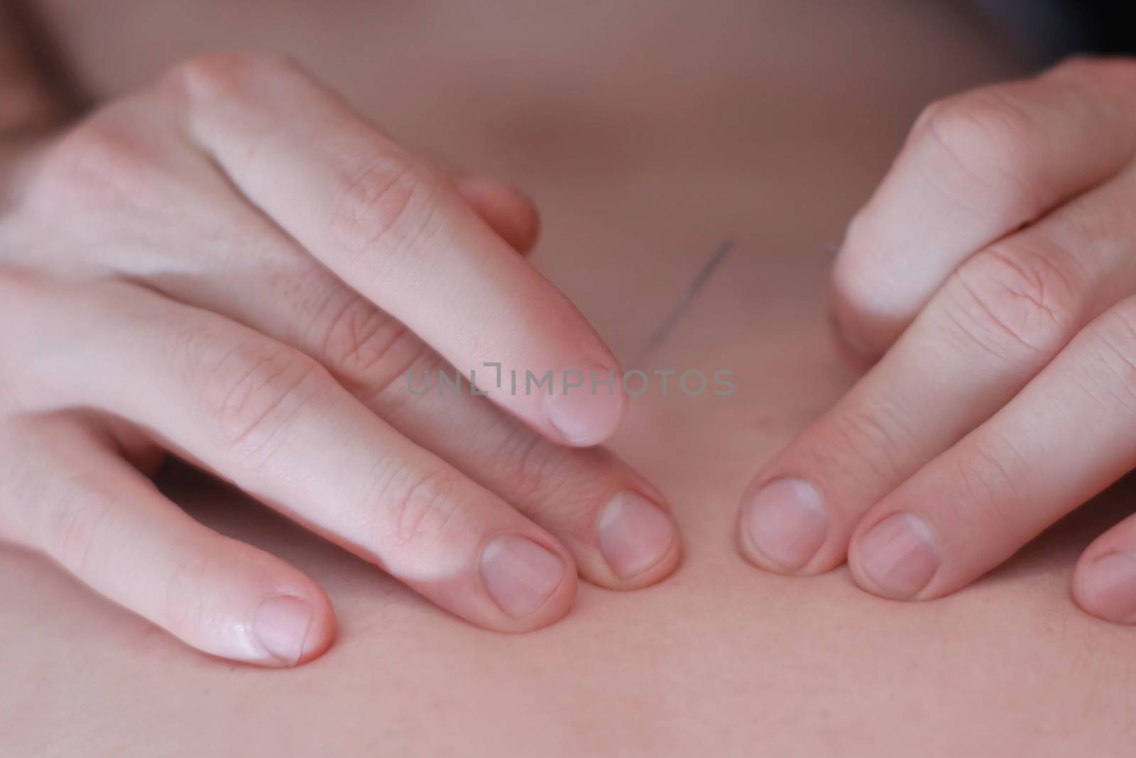 Acupuncture, is used to relieve pain or for medicinal purposes. The benefits of acupuncture. Body care , stimulating an acupuncture needle on the back of a patient. by nkooume