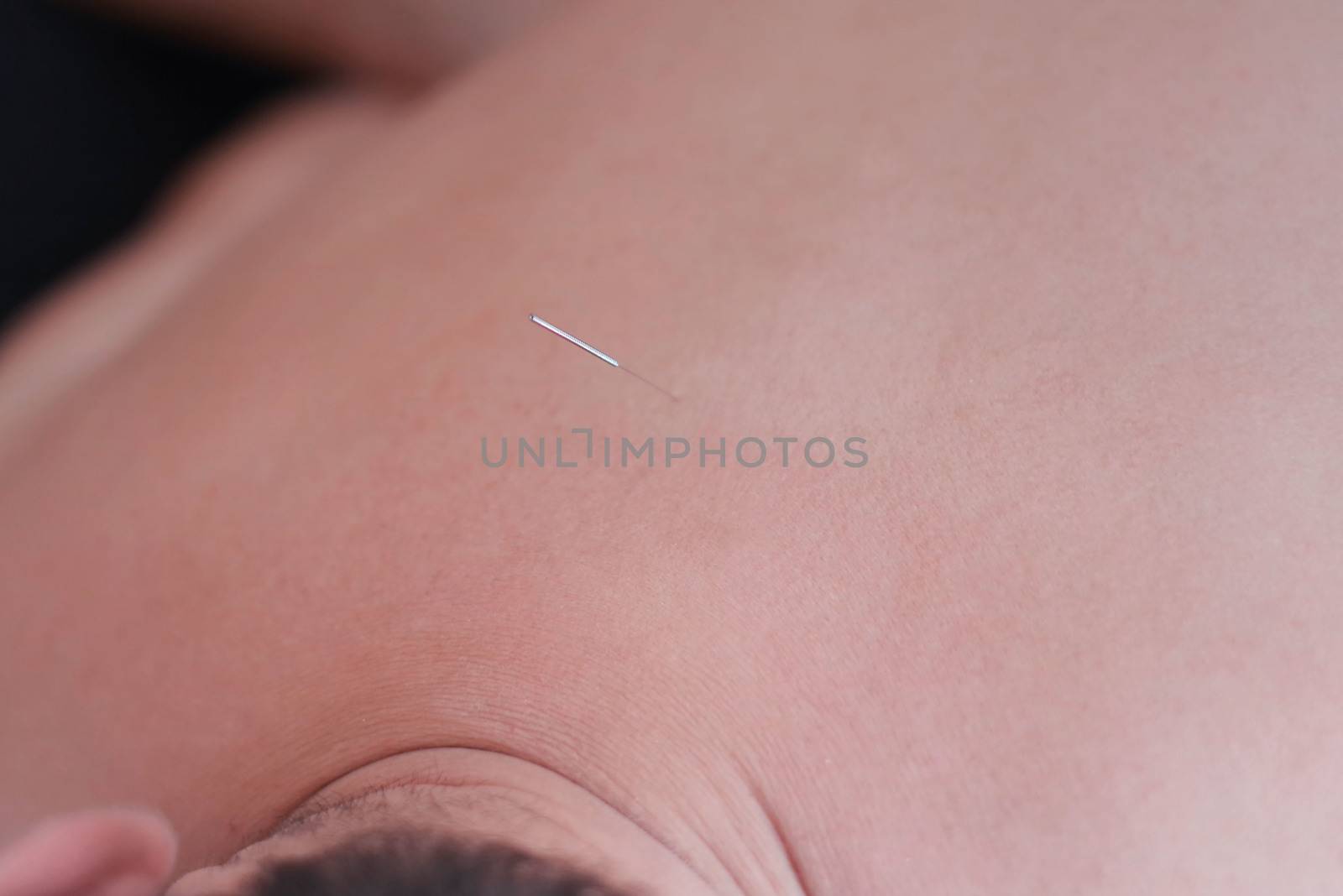 Acupuncture, is used to relieve pain or for medicinal purposes. The benefits of acupuncture. Body care , stimulating an acupuncture needle on the back of a patient. by nkooume